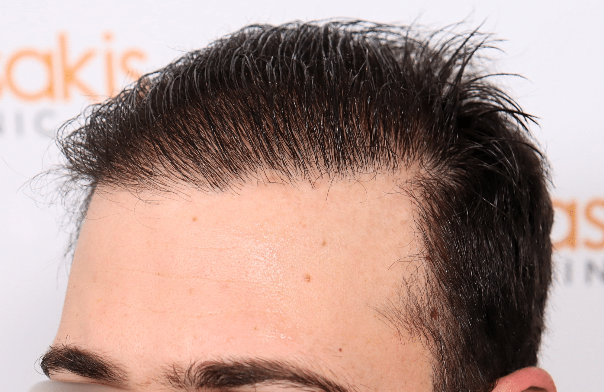 hair transplant result 12 months post op with 3500 fus anastasakis hair clinic side2 after wet hair