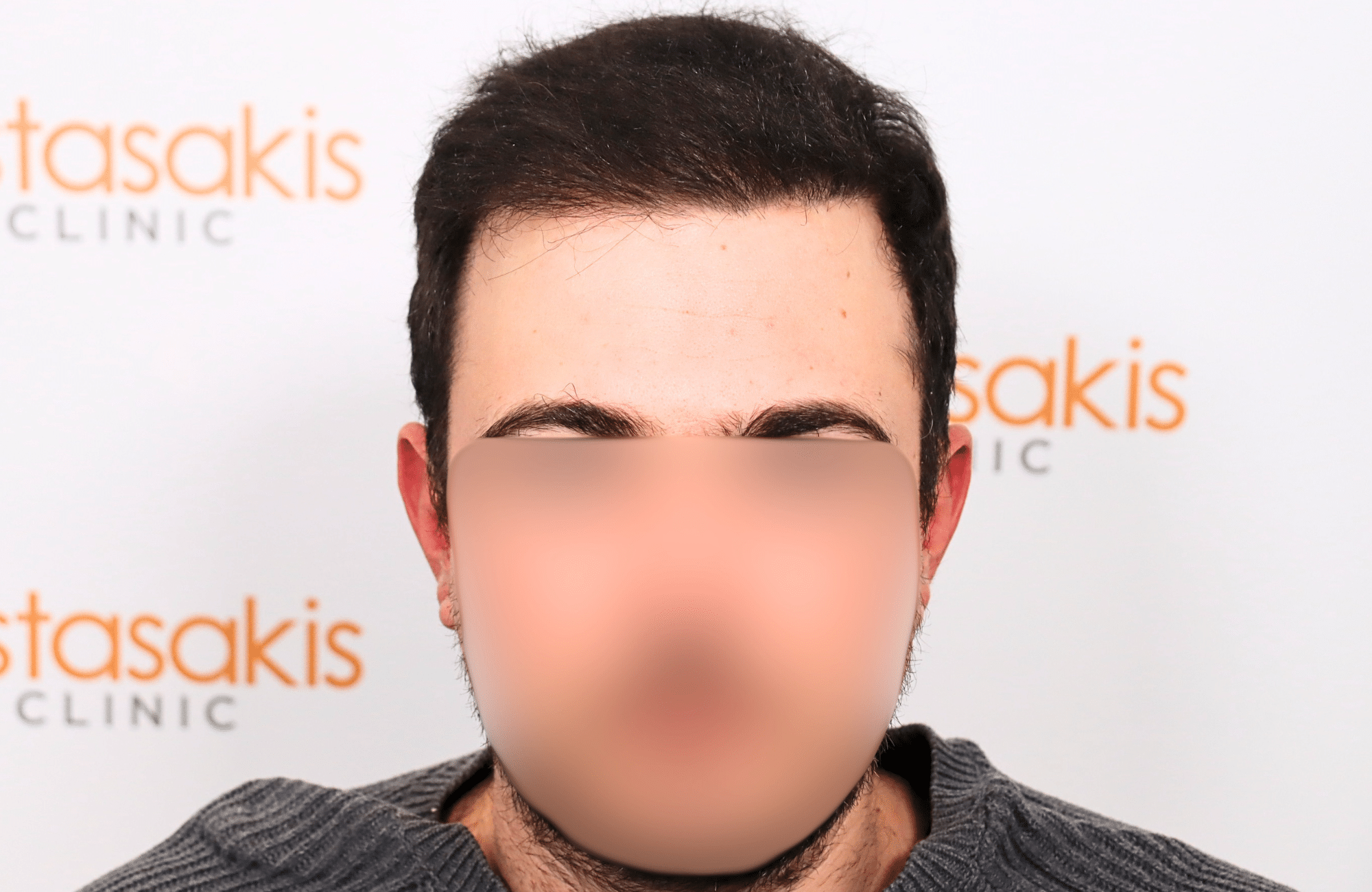 hair transplant result 12 months post op with 3500 fus anastasakis hair clinic fullface after
