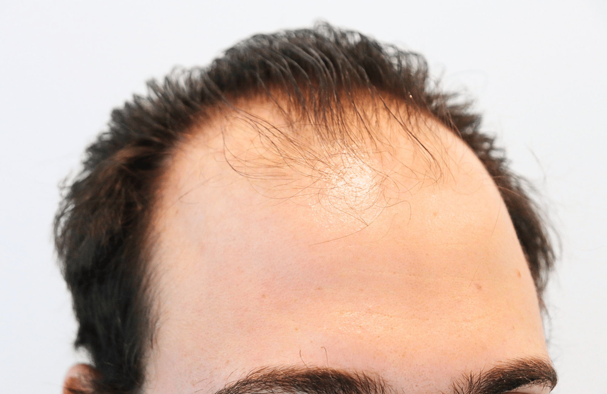 hair transplant result 12 months post op with 3500 fus anastasakis hair clinic side1 before