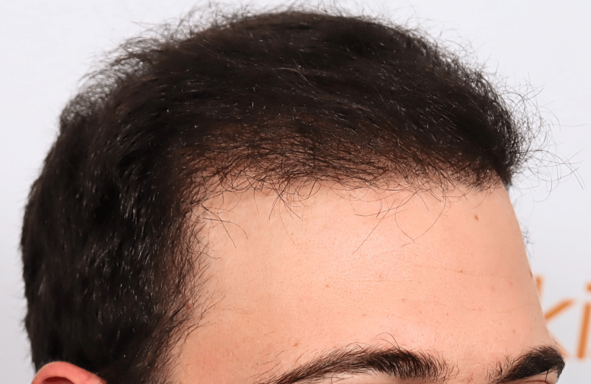 hair transplant result 12 months post op with 3500 fus anastasakis hair clinic side1 after