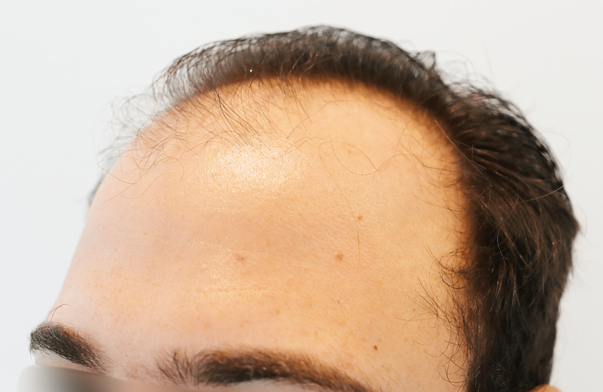 hair transplant result 12 months post op with 3500 fus anastasakis hair clinic side2 before
