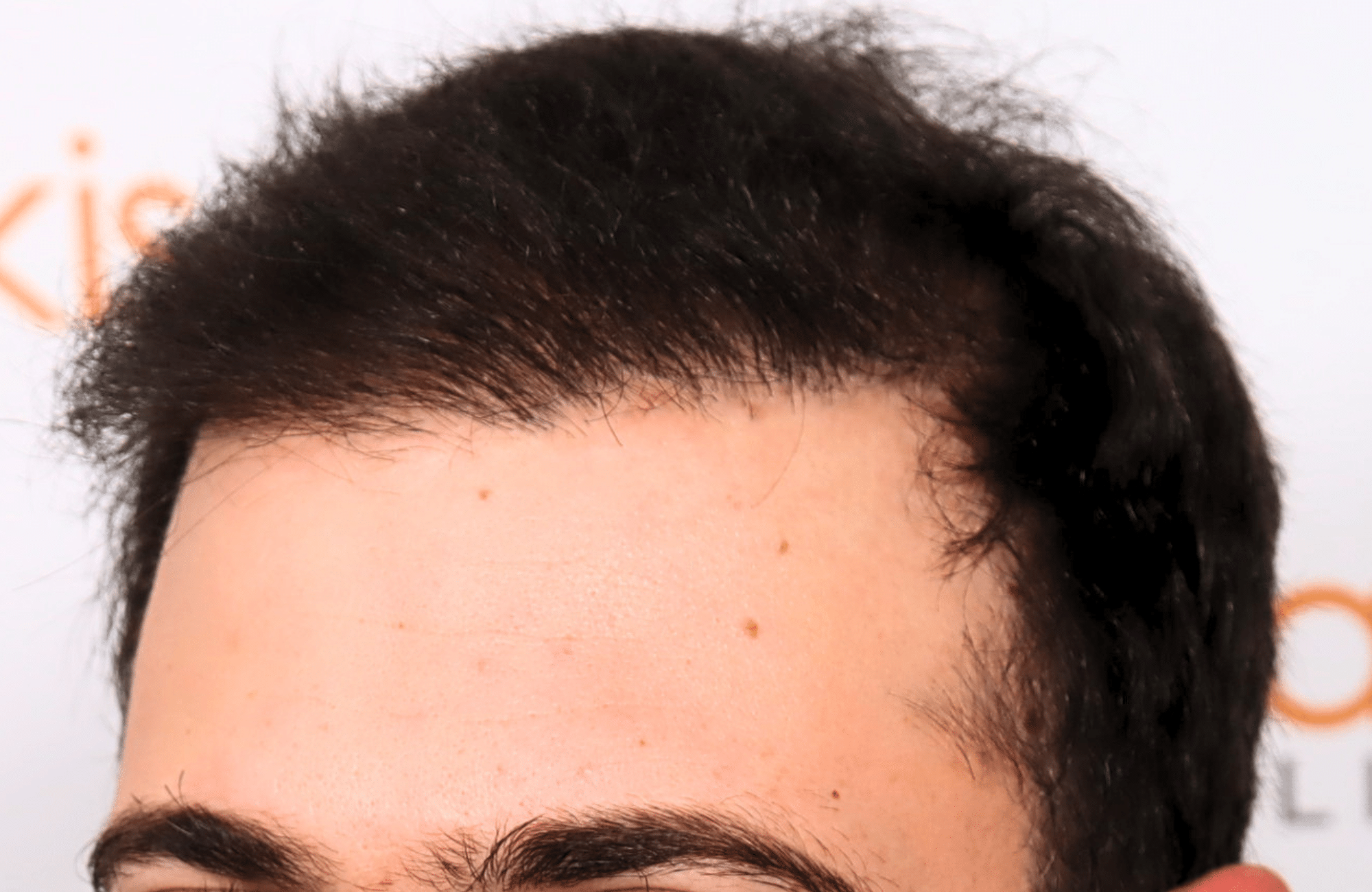 hair transplant result 12 months post op with 3500 fus anastasakis hair clinic side2 after