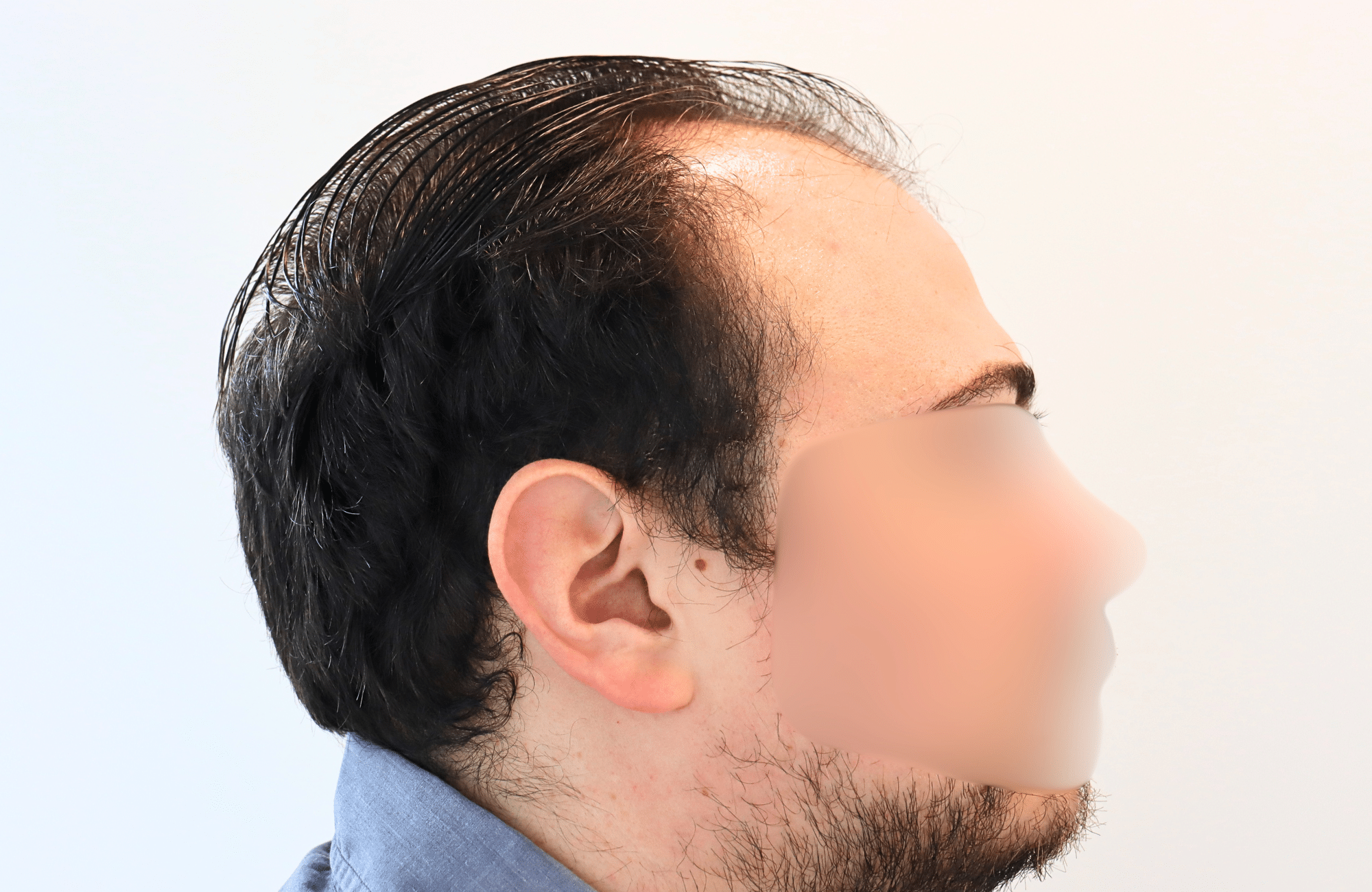 hair transplant result 12 months post op with 3500 fus anastasakis hair clinic side3 before