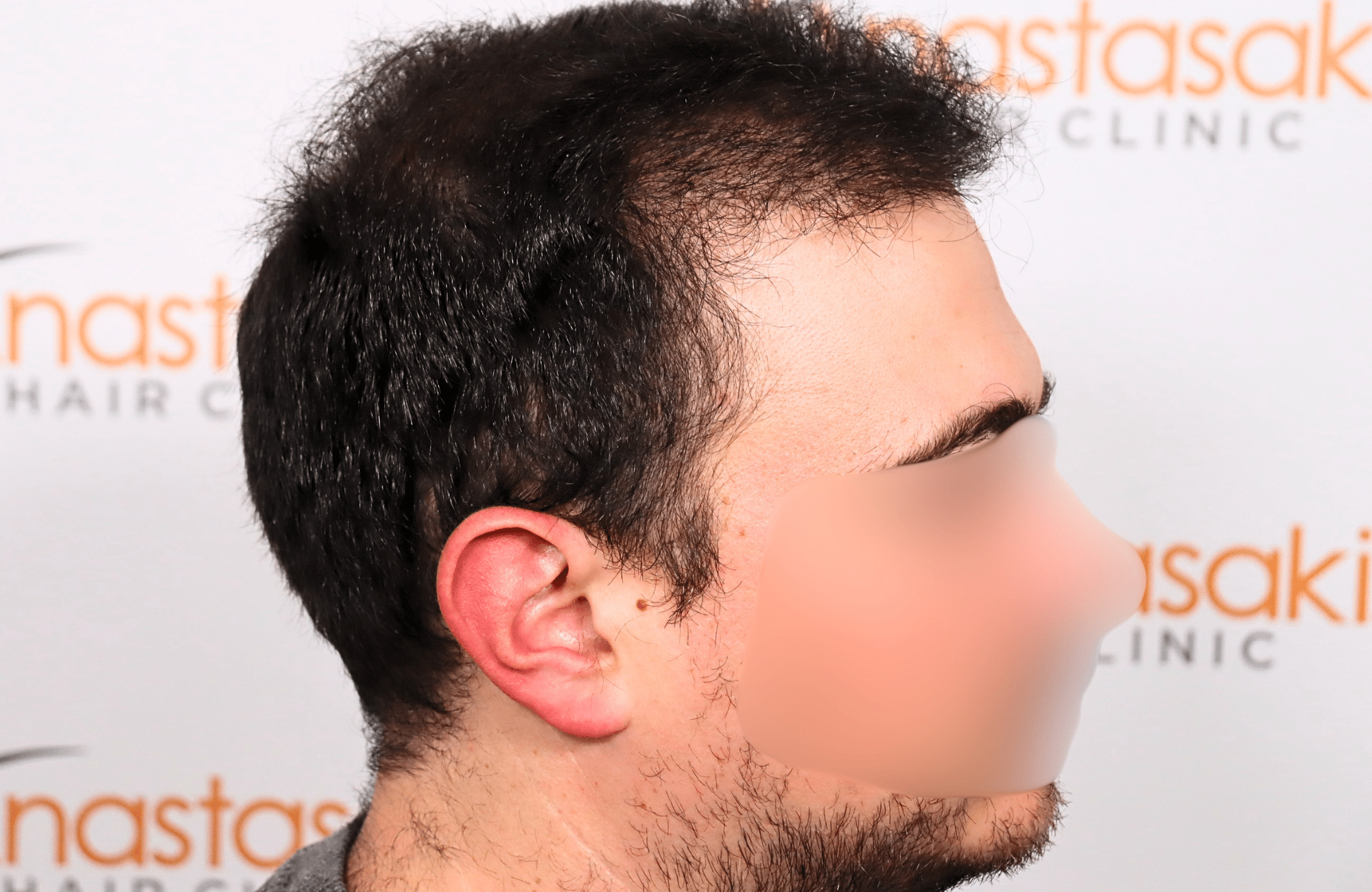 hair transplant result 12 months post op with 3500 fus anastasakis hair clinic side3 after
