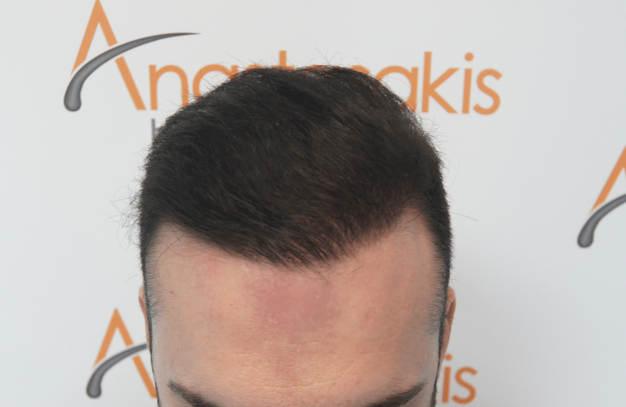 hair transplant with 3500 fus fue after - up