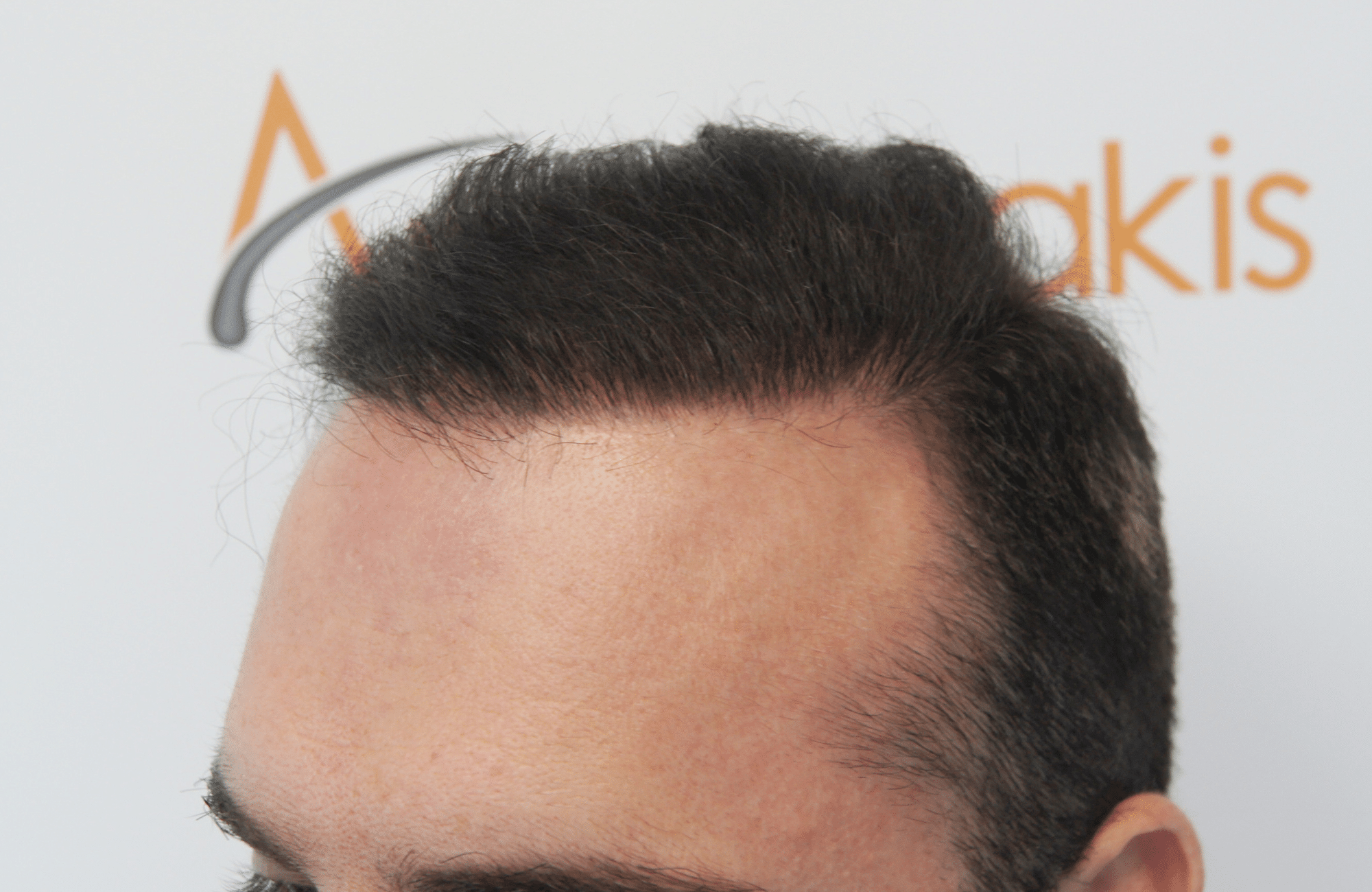 hair transplant with 3500 fus fue after - fullfaceside1