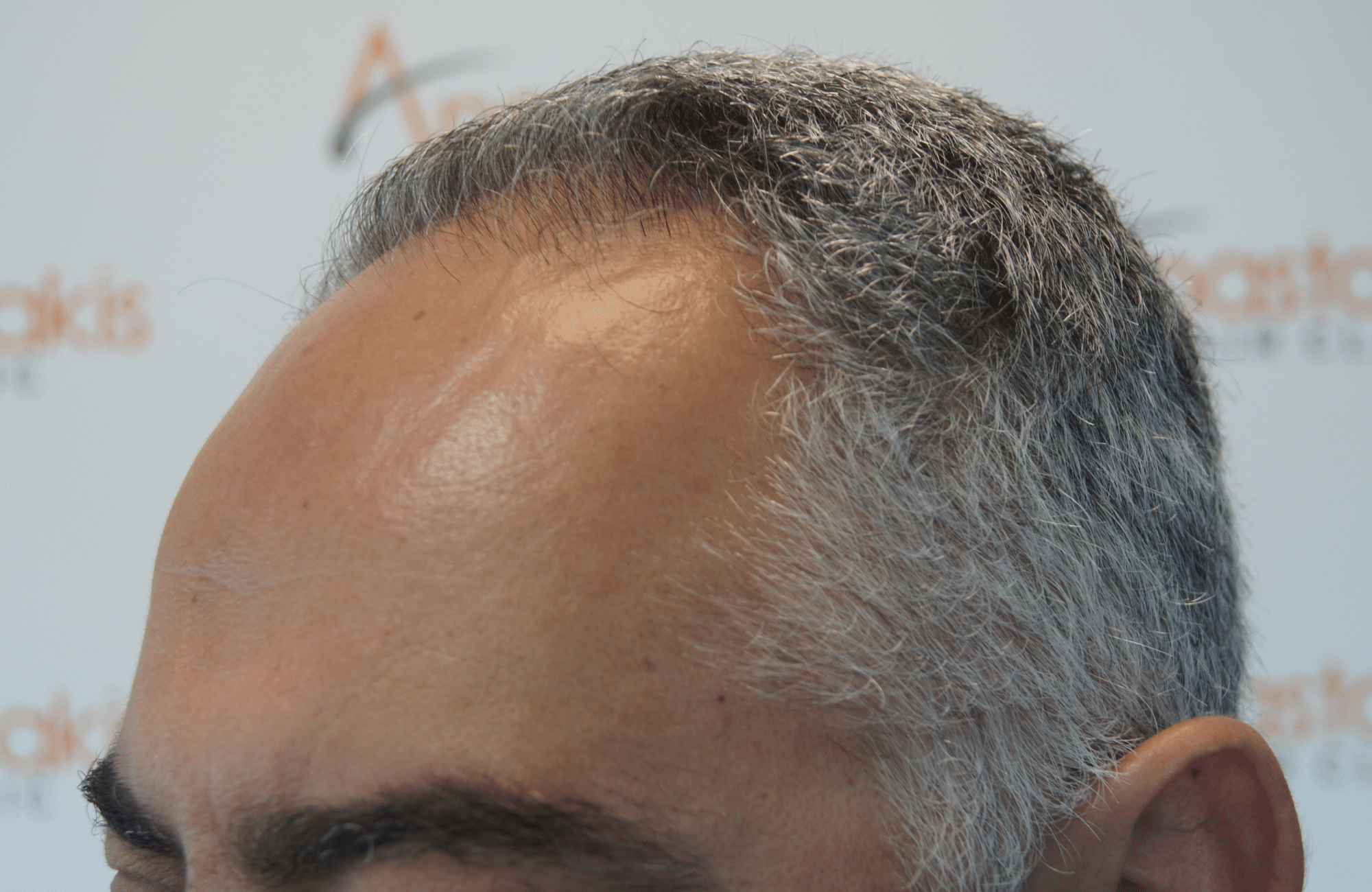 hair transplant result with 2600 follicular units anastasakis hair clinic