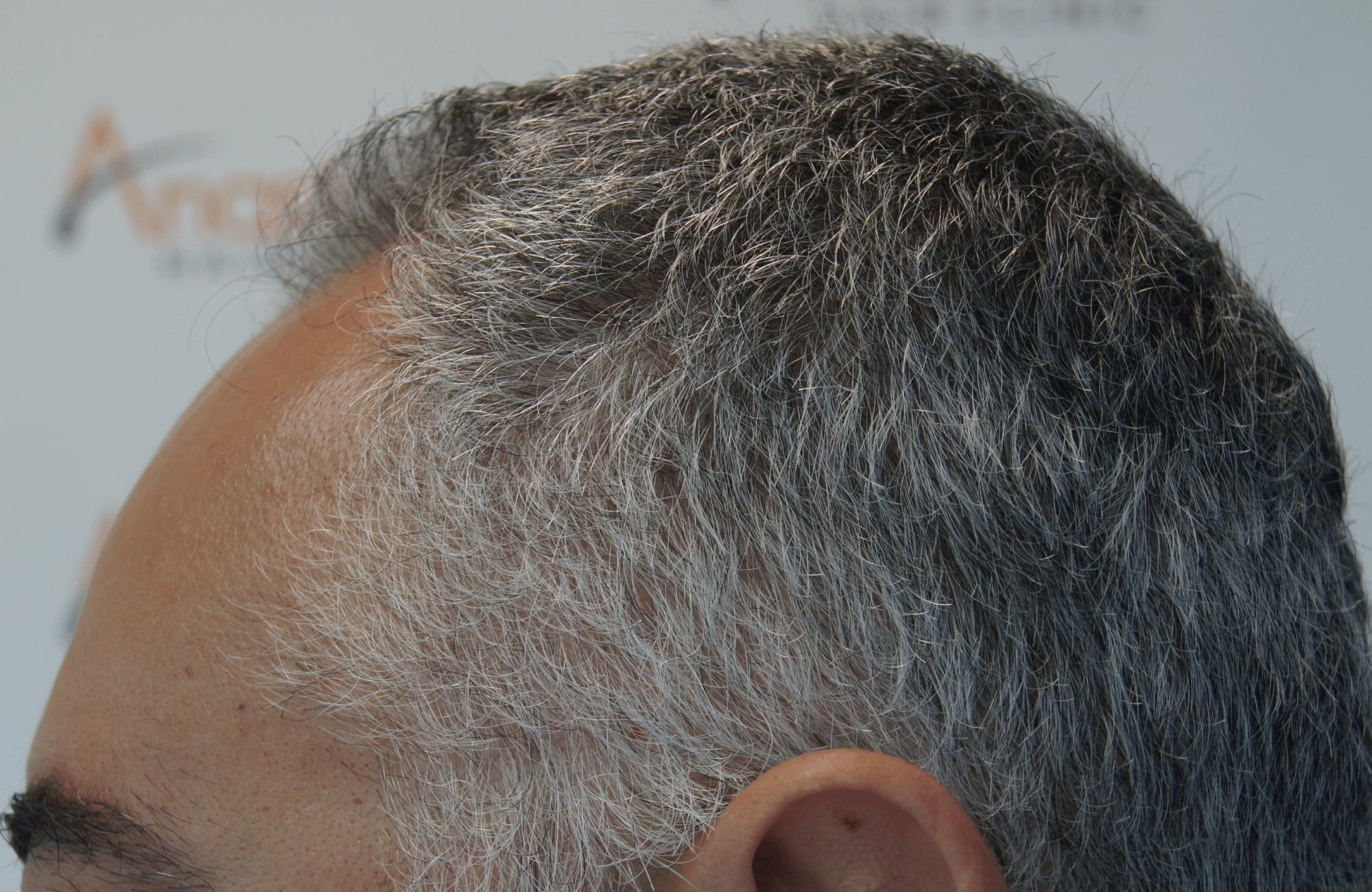 hair transplant result with 2600 follicular units anastasakis hair clinic