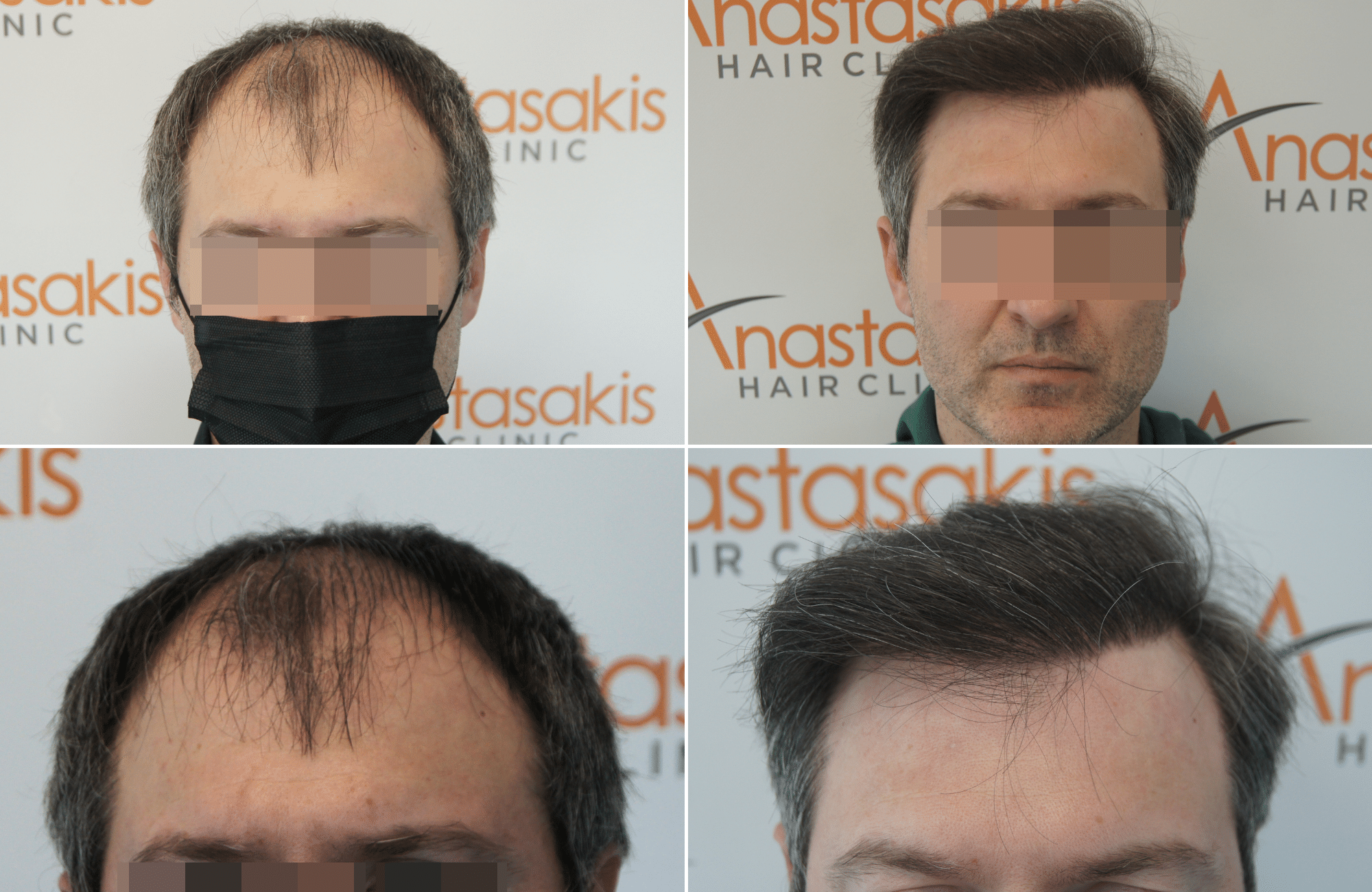 https://anastasakishairclinic.com/portfolio/ahc-apotelesma-metamosxefsis-mallion-anastasakis-hair-clinic-203/