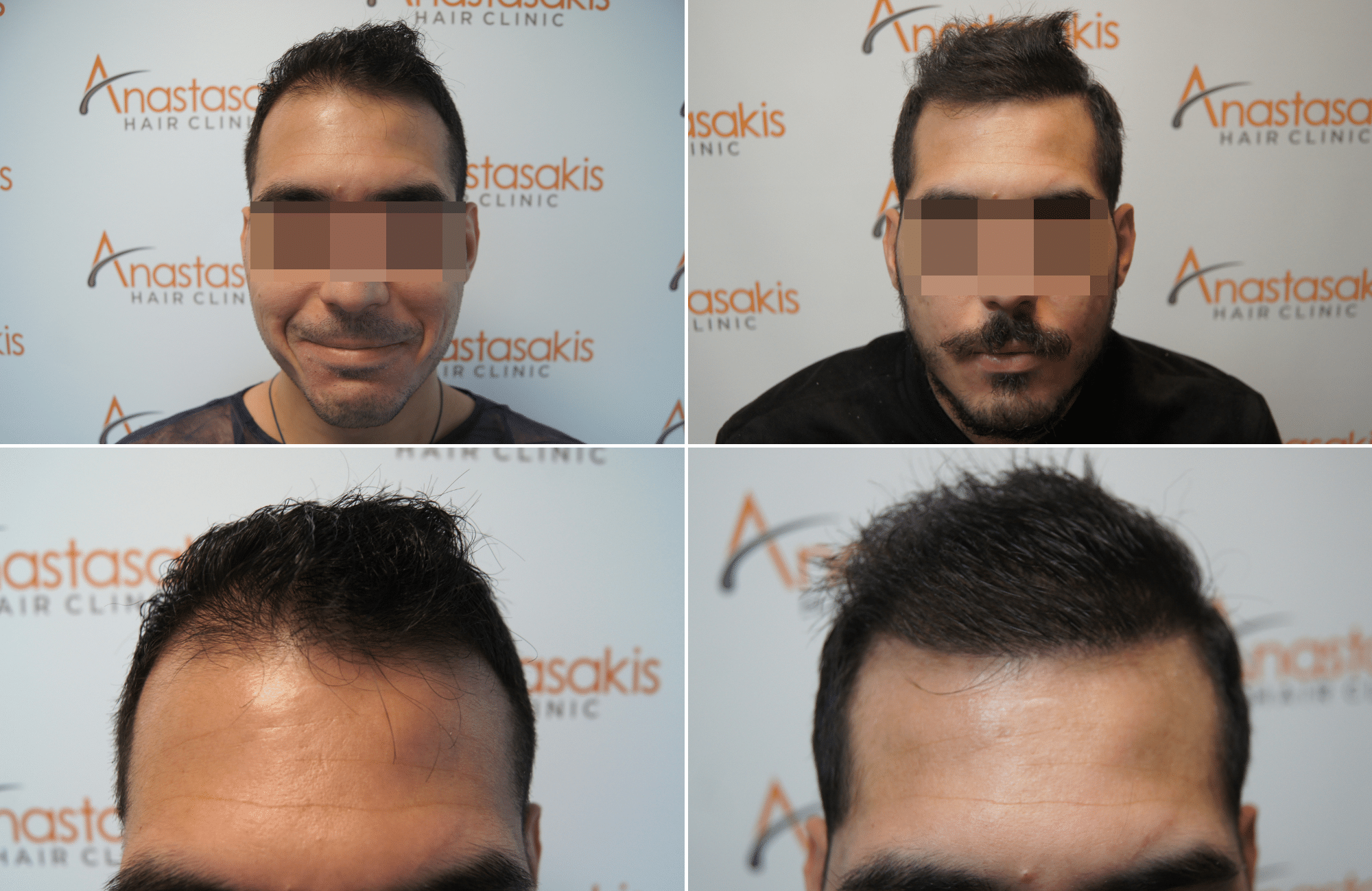https://anastasakishairclinic.com/portfolio/apotelesma-metamosxefsis-mallion-anastasakis-hair-clinic-50/