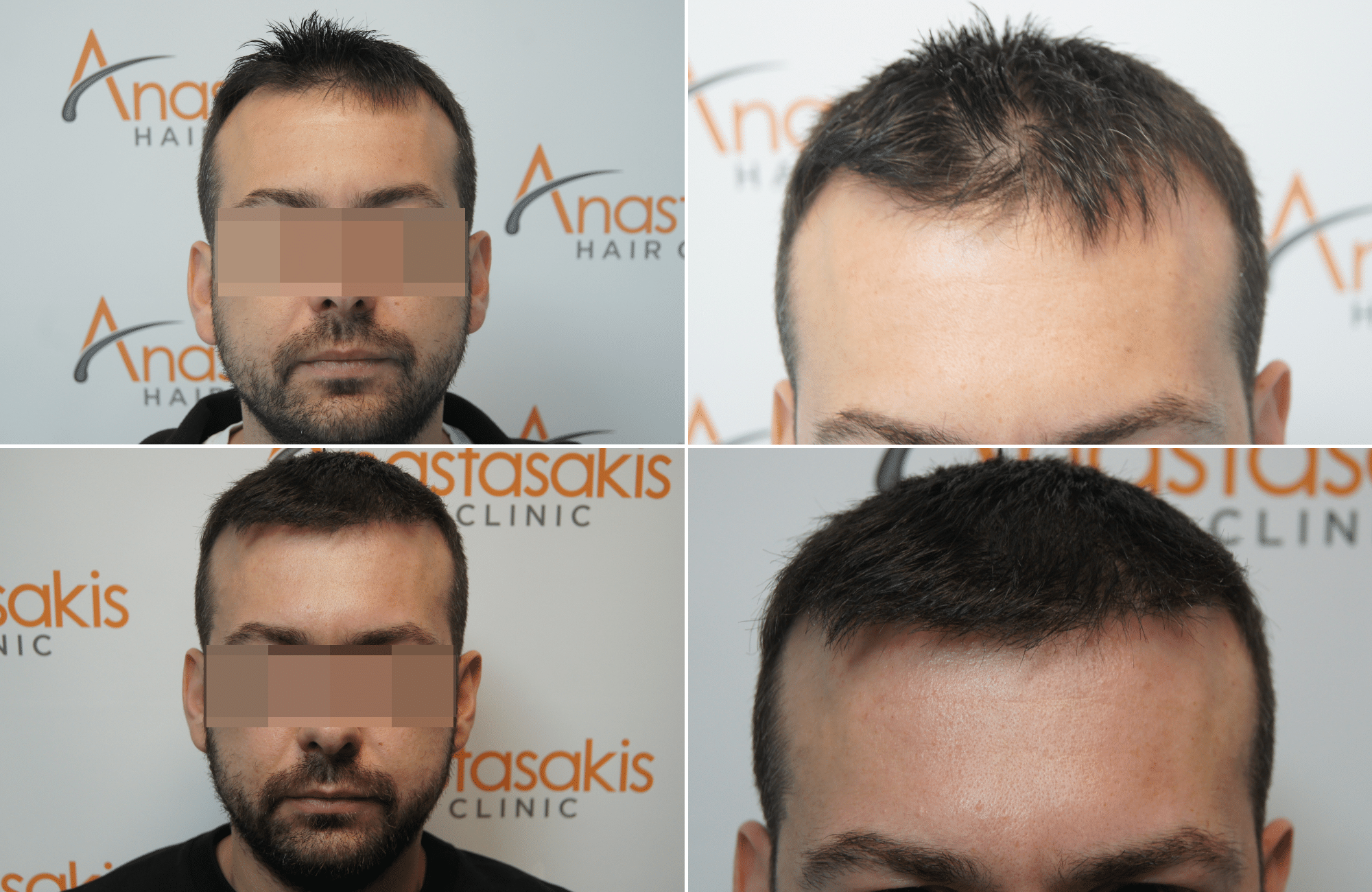 https://anastasakishairclinic.com/portfolio/apotelesma-metamosxefsis-mallion-anastasakis-hair-clinic-120/