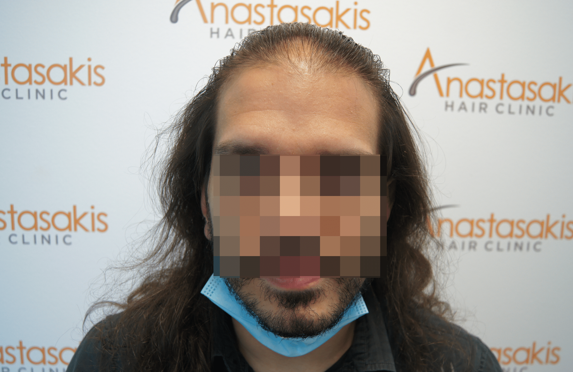 φυσικό αποτελεσμα πυκνωσης στη μεταμόσχευση μαλλιων στην anastasakis hair clinic ΜΕ 2500 ΤΡΙΧΟΘΥΛΑΚΙΑ anastasakis hair clinic