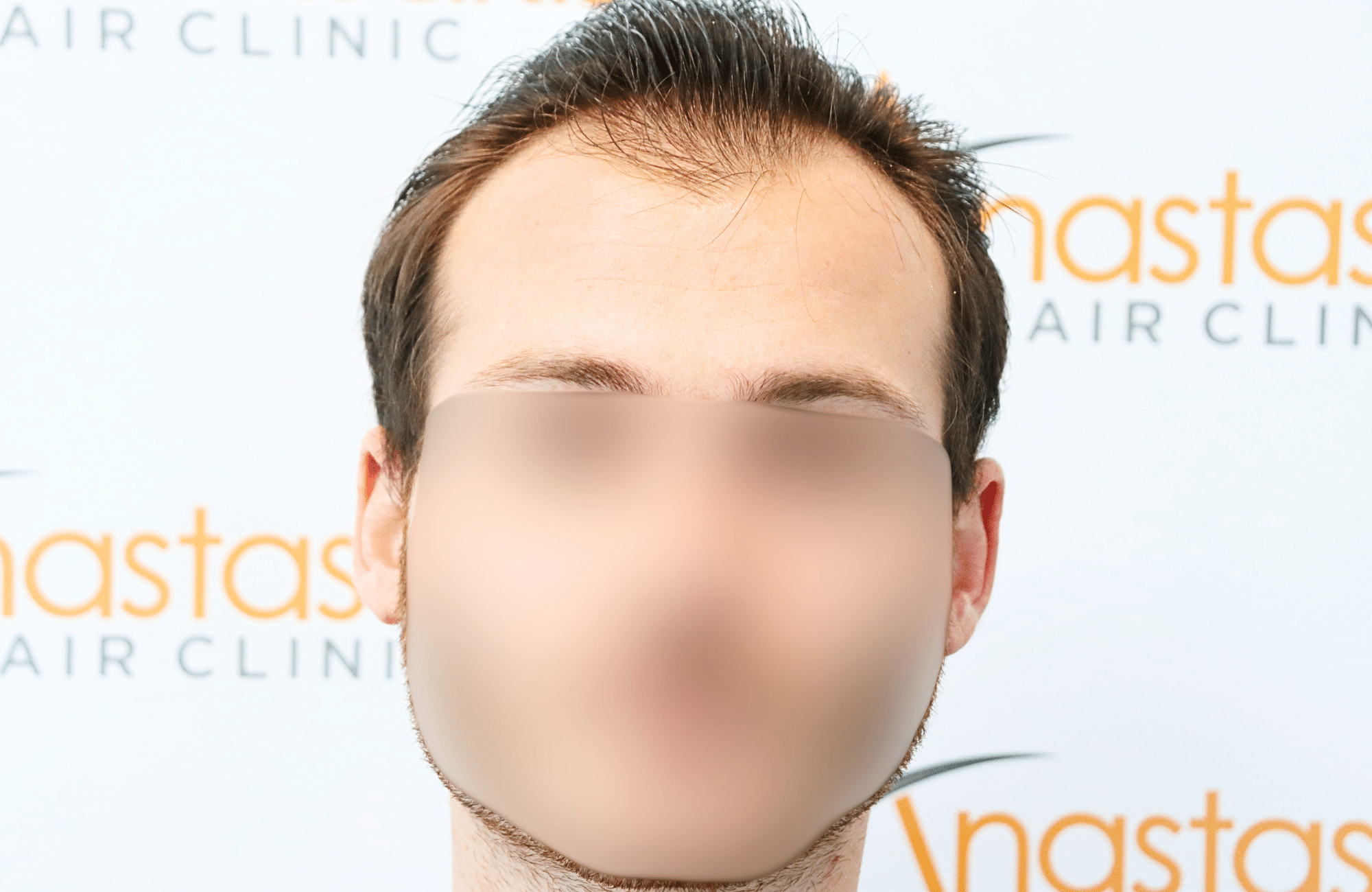 hair transplant result with 2500 fus with fue anastasakis hair clinic fullface before