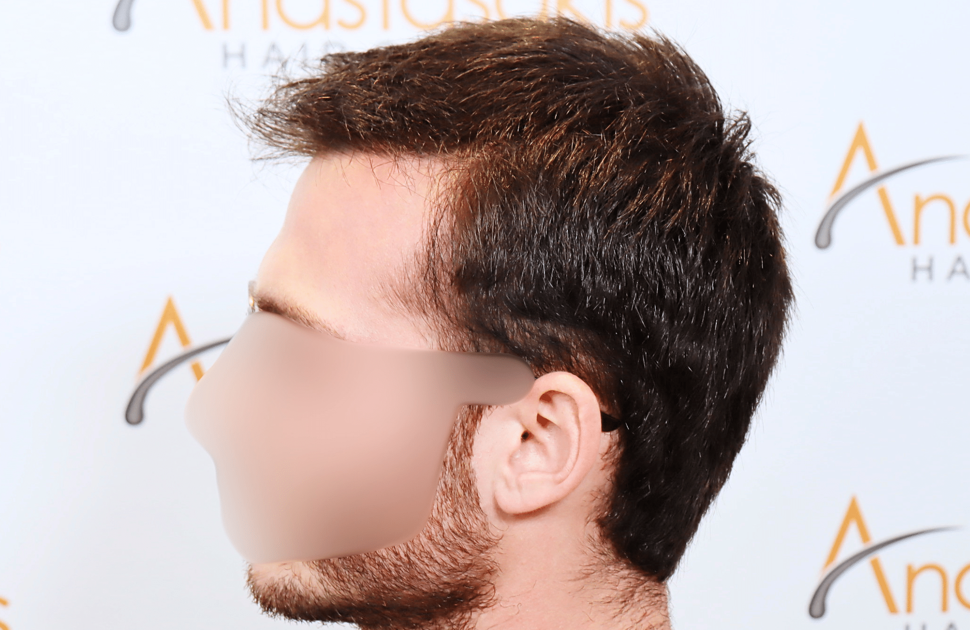hair transplant result with 2500 fus with fue anastasakis hair clinic side3 after