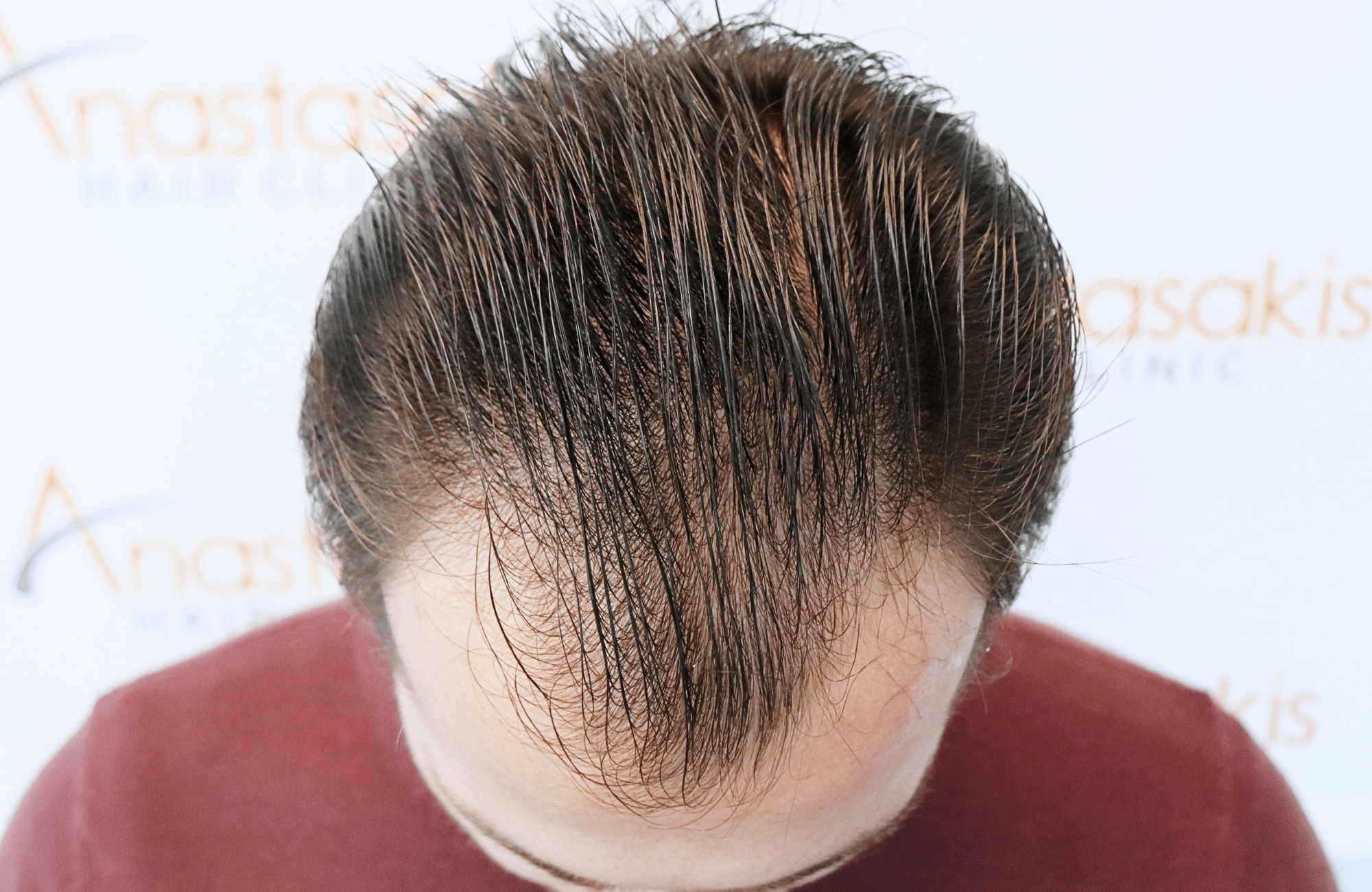 hair transplant result with 2500 fus with fue anastasakis hair clinic frontal before