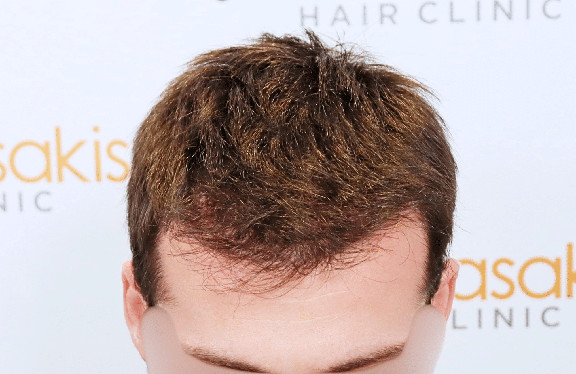 hair transplant result with 2500 fus with fue anastasakis hair clinic frontal after