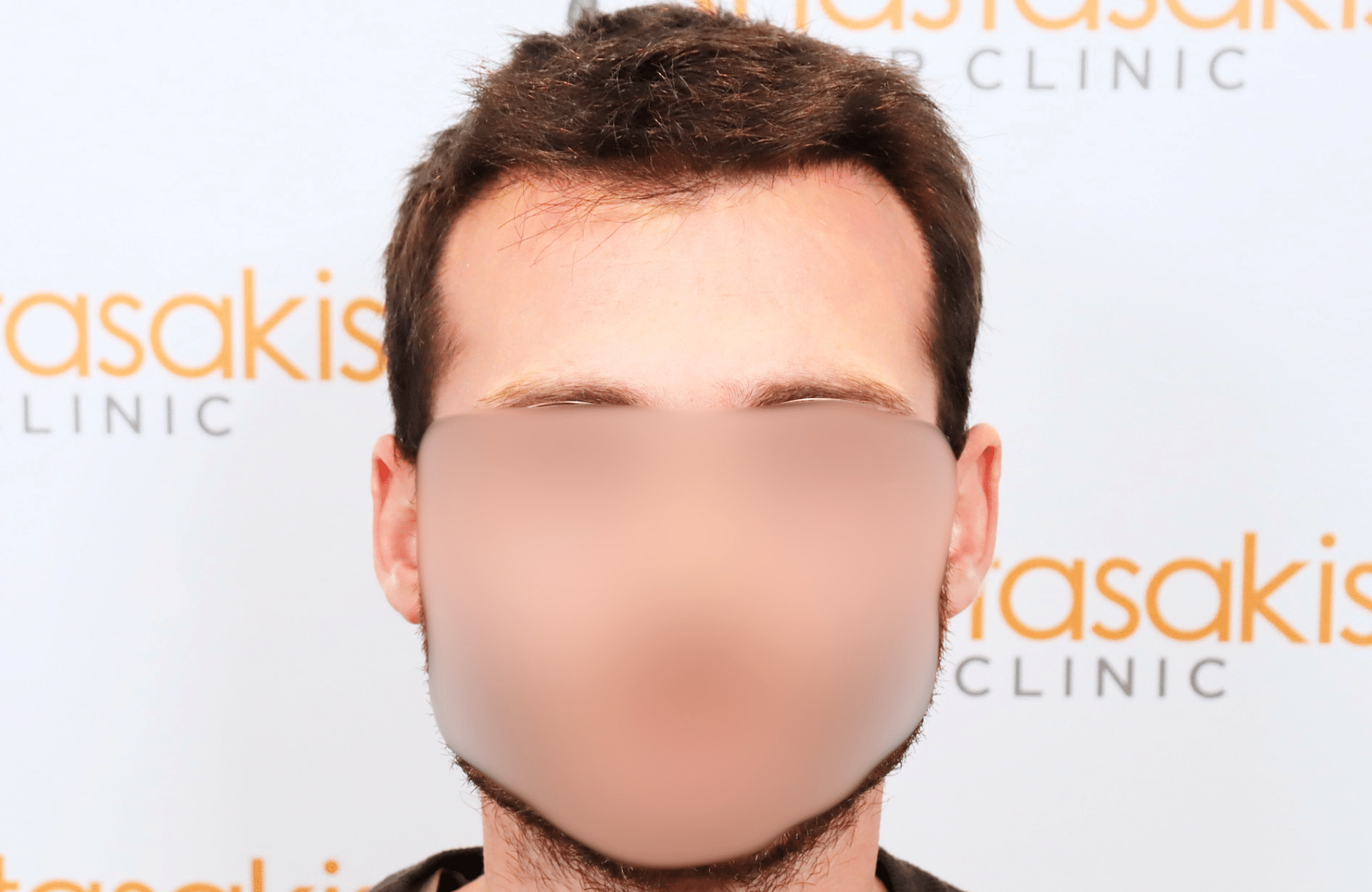 hair transplant result with 2500 fus with fue anastasakis hair clinic fullface after
