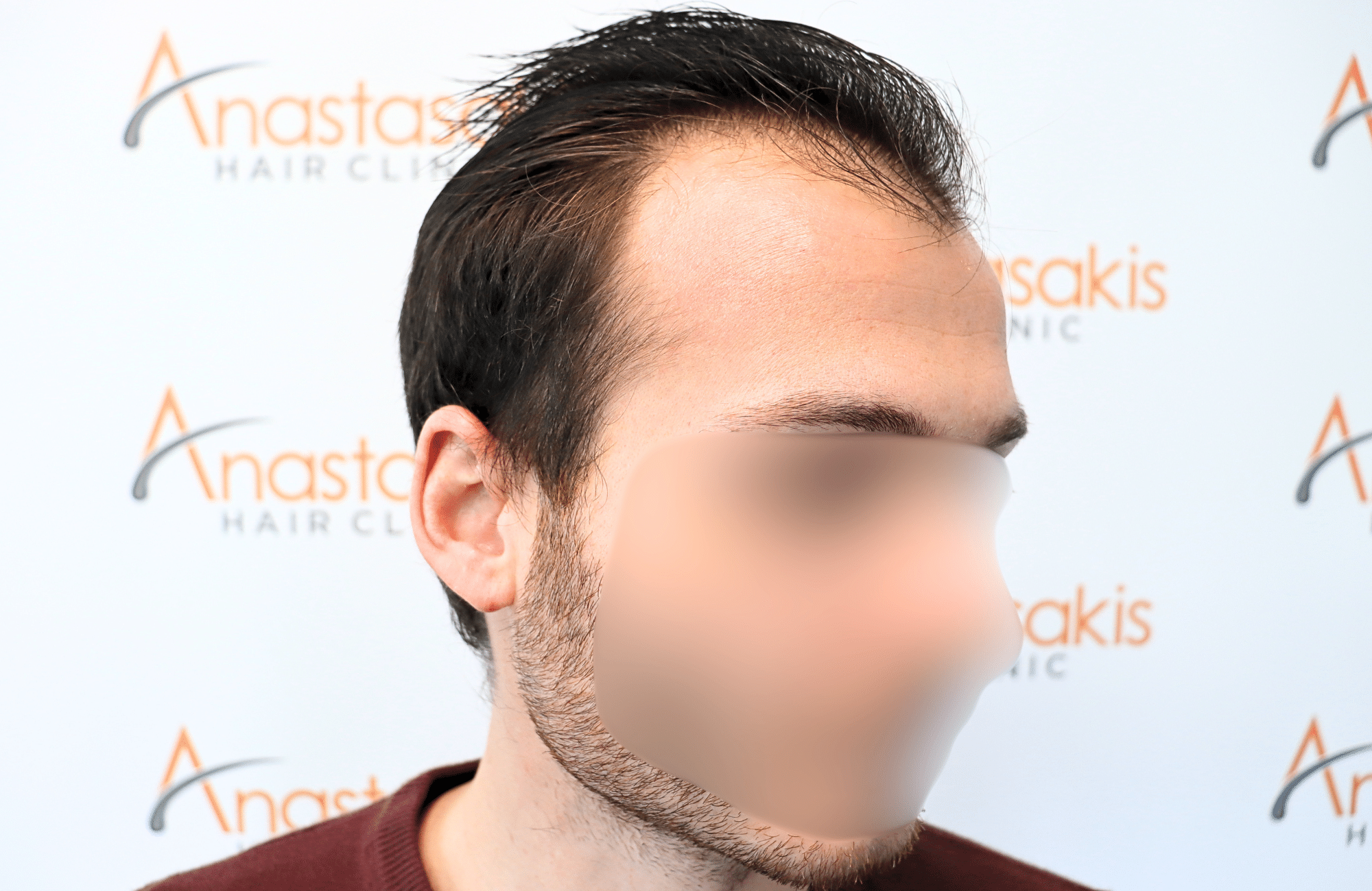 hair transplant result with 2500 fus with fue anastasakis hair clinic side1 before