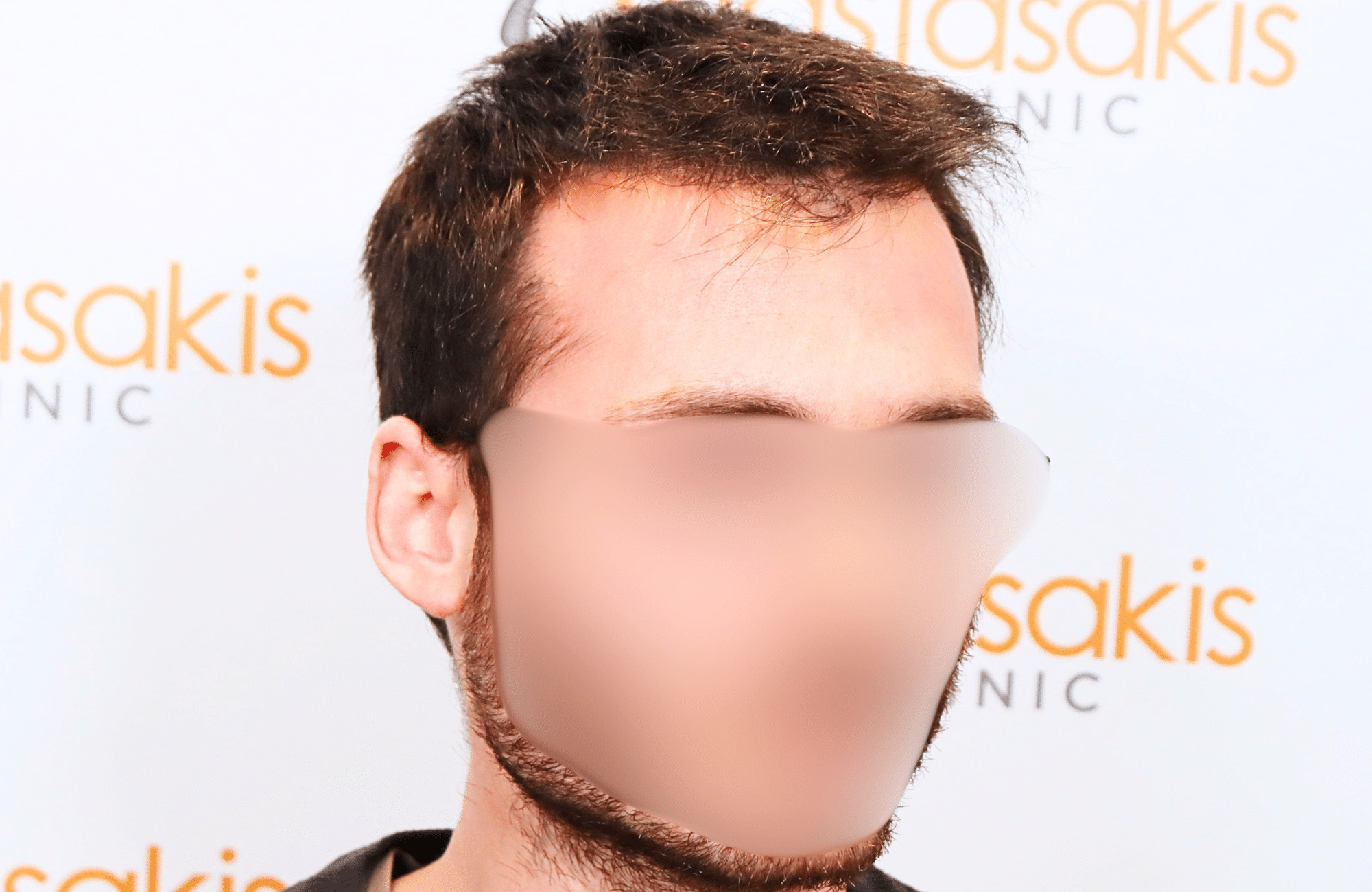 hair transplant result with 2500 fus with fue anastasakis hair clinic side1 after