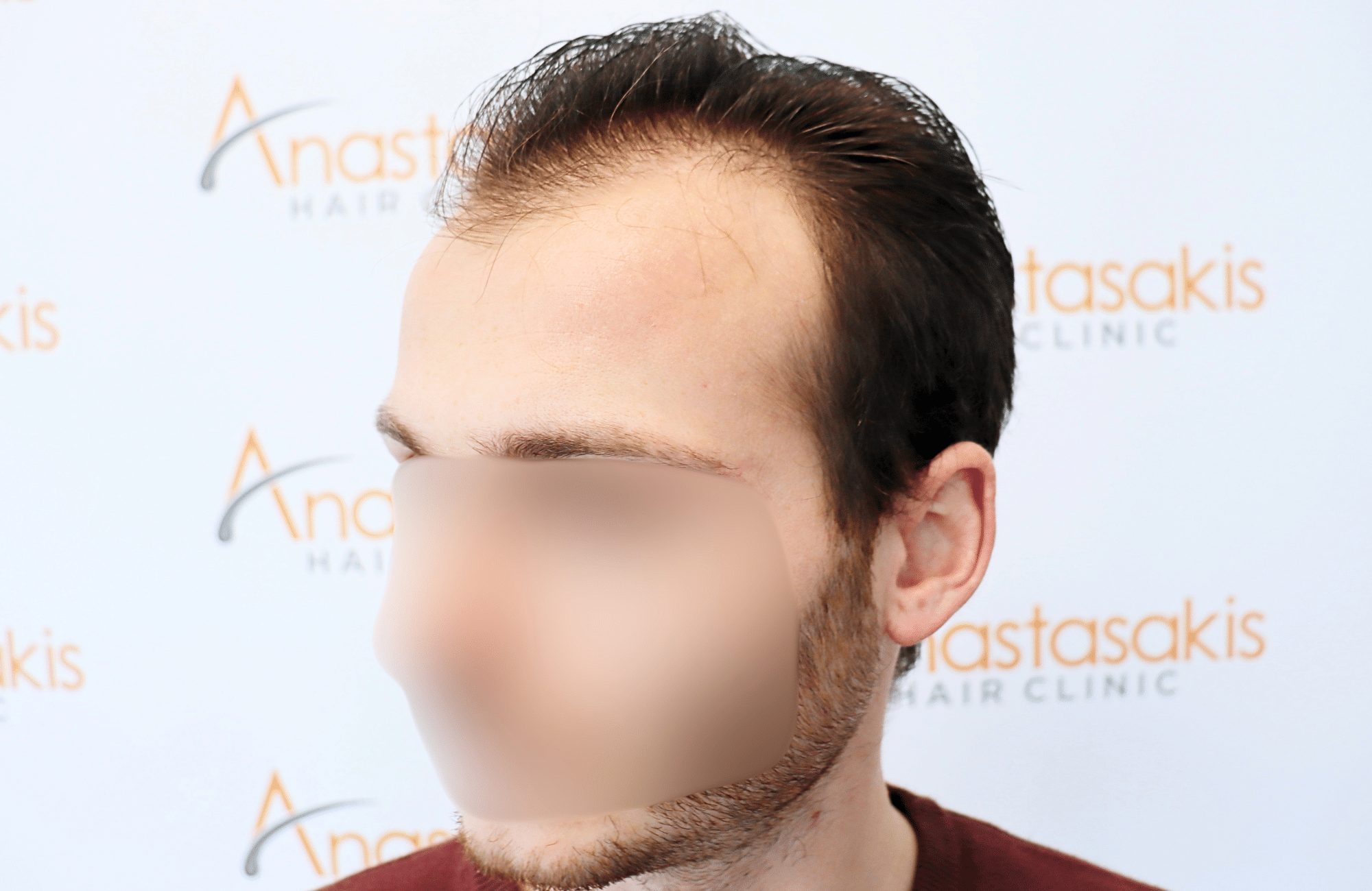 hair transplant result with 2500 fus with fue anastasakis hair clinic side2 before