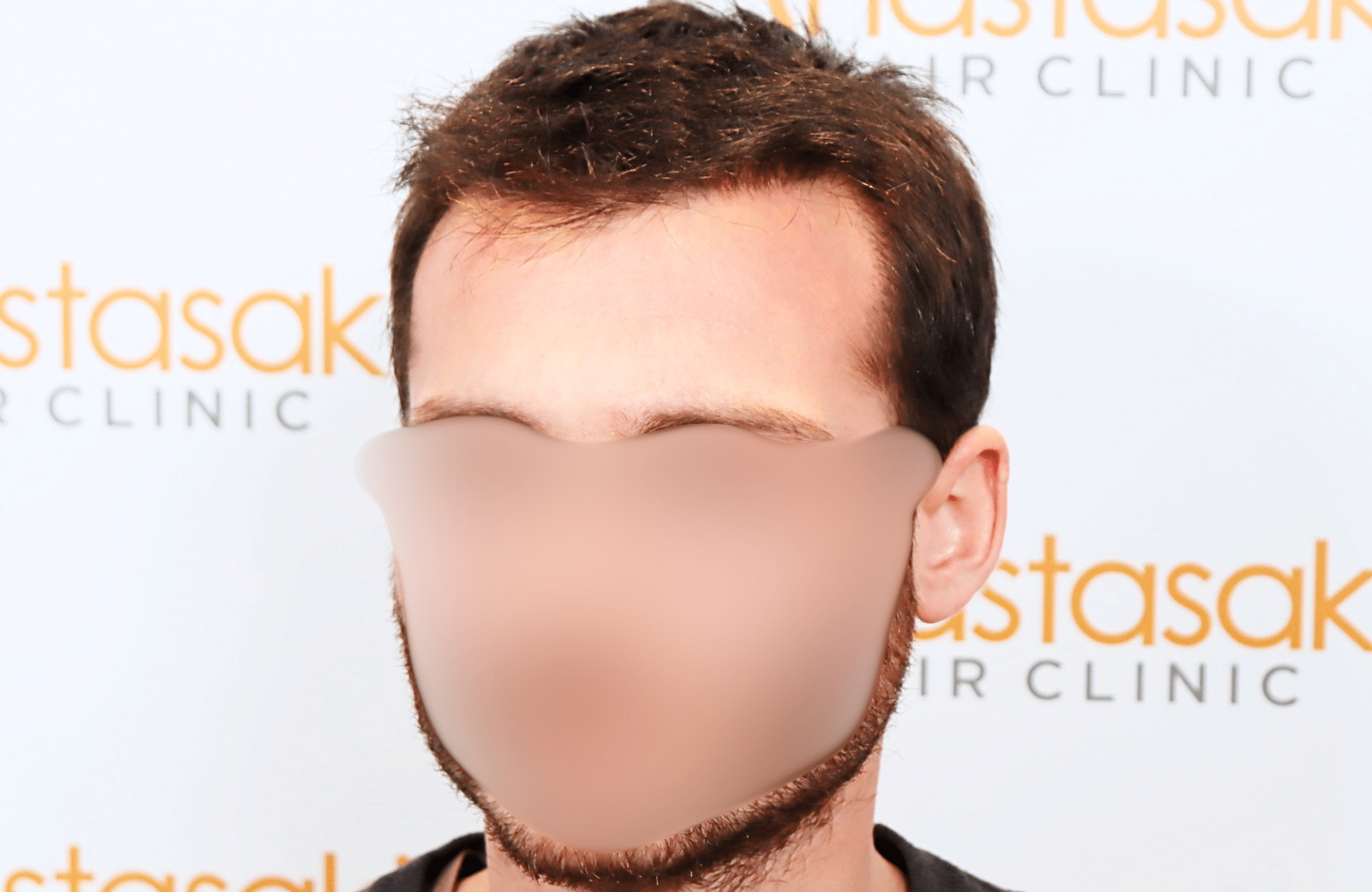 hair transplant result with 2500 fus with fue anastasakis hair clinic side2 after