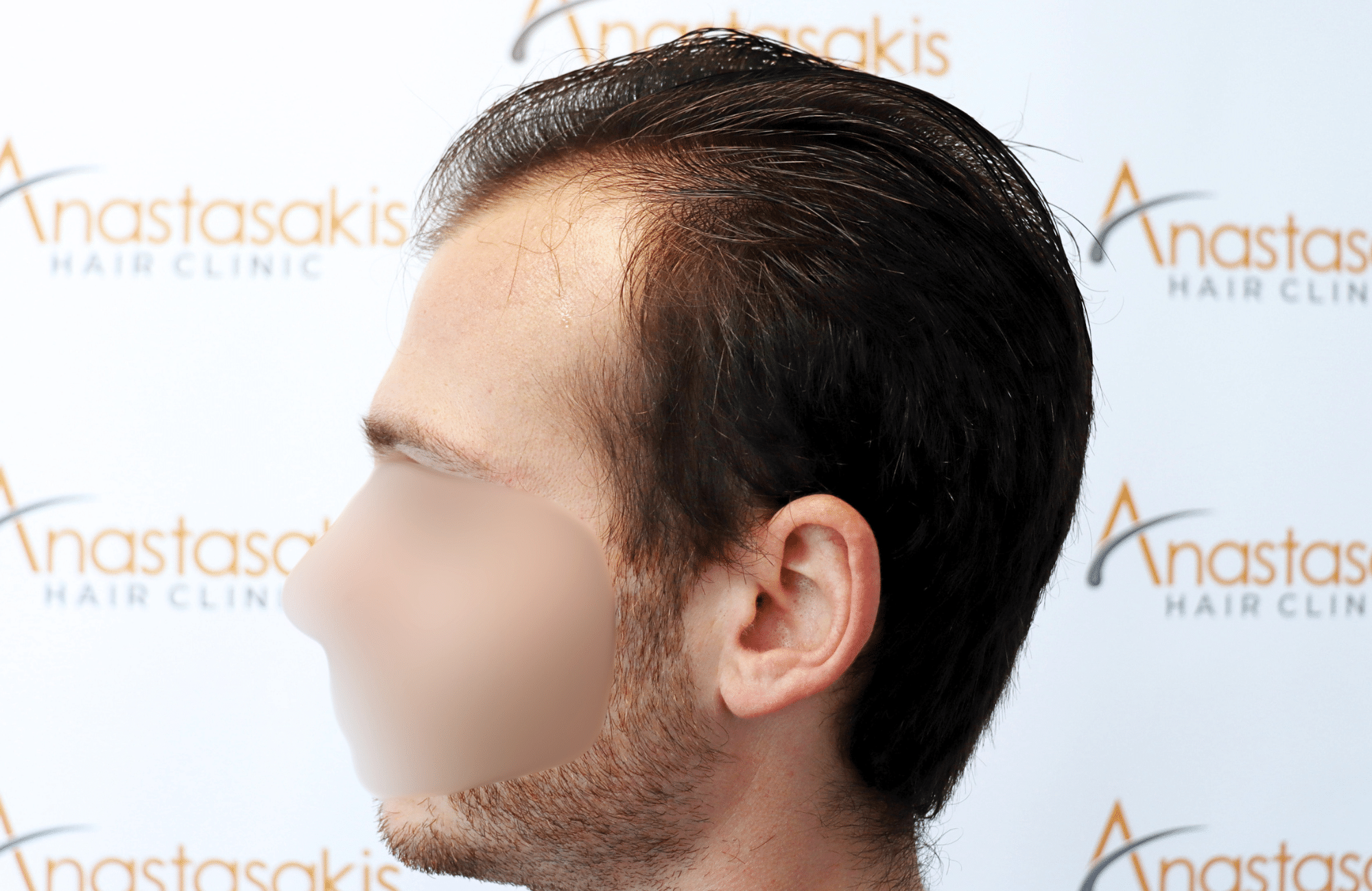hair transplant result with 2500 fus with fue anastasakis hair clinic side3 before