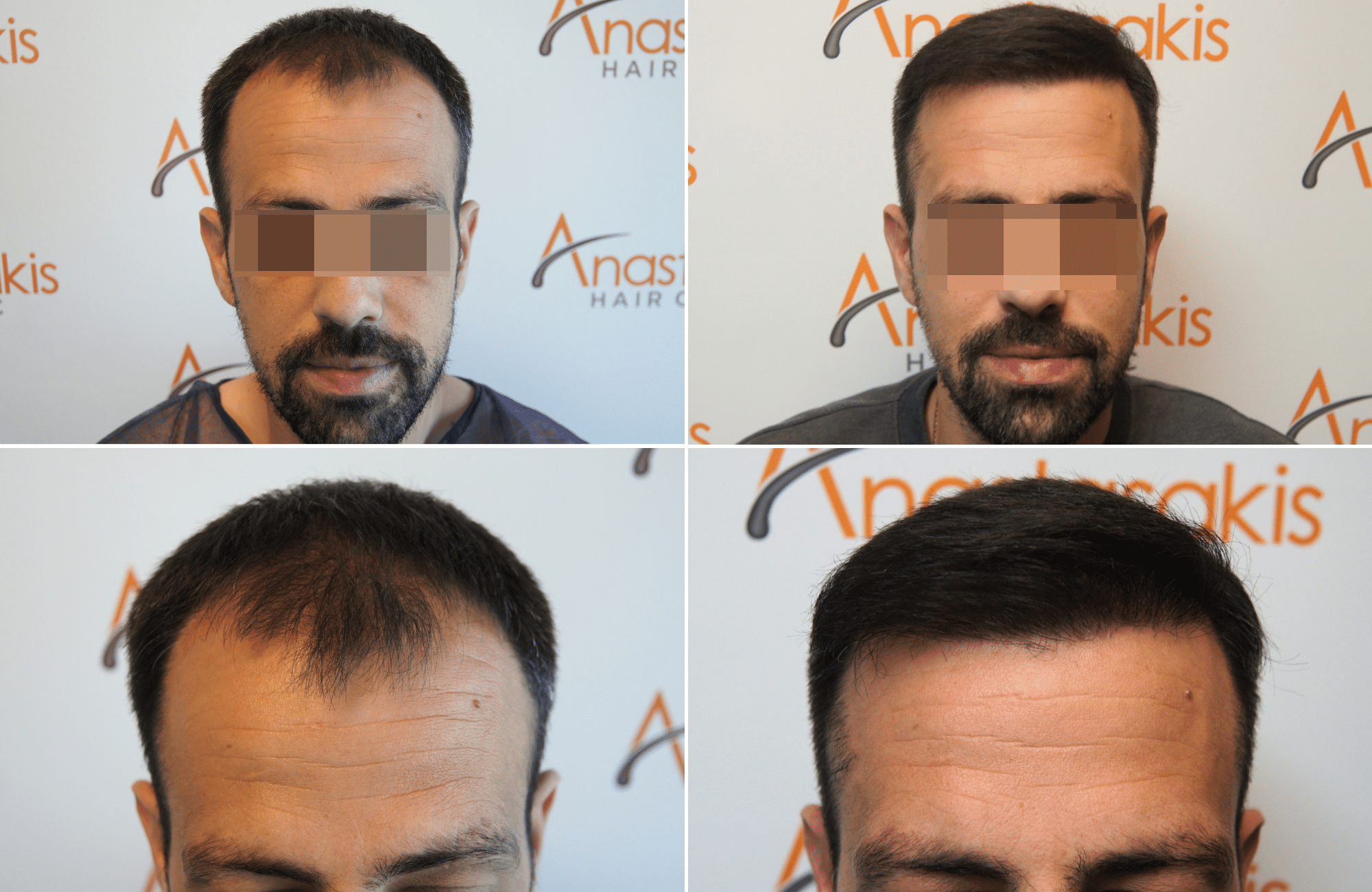https://anastasakishairclinic.com/portfolio/apotelesma-metamosxefsis-mallion-anastasakis-hair-clinic-76/