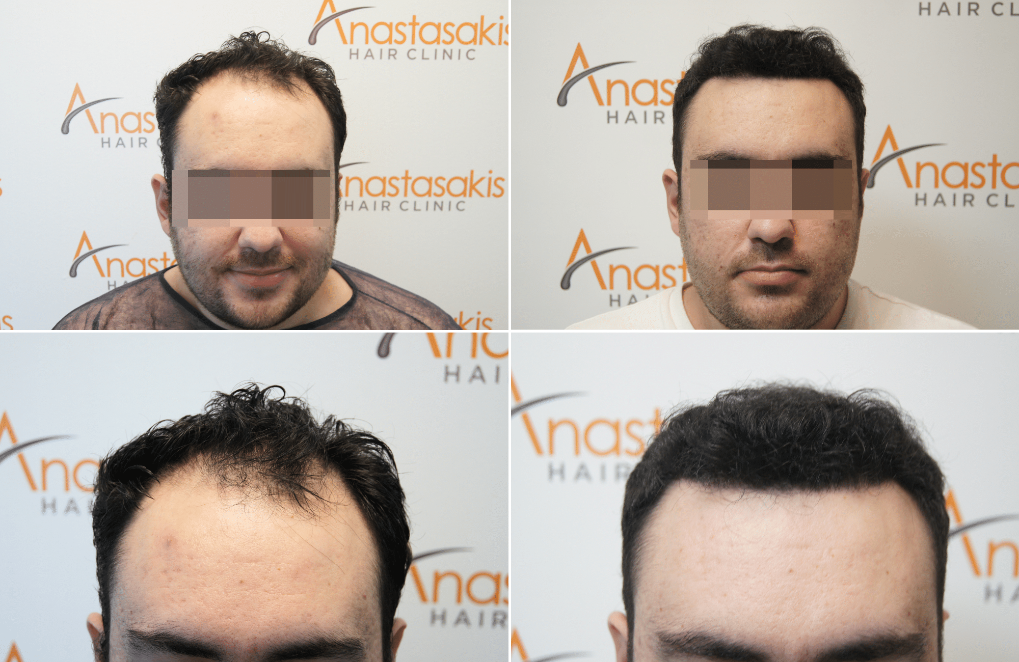 https://anastasakishairclinic.com/portfolio/apotelesma-metamosxefsis-mallion-anastasakis-hair-clinic-476/