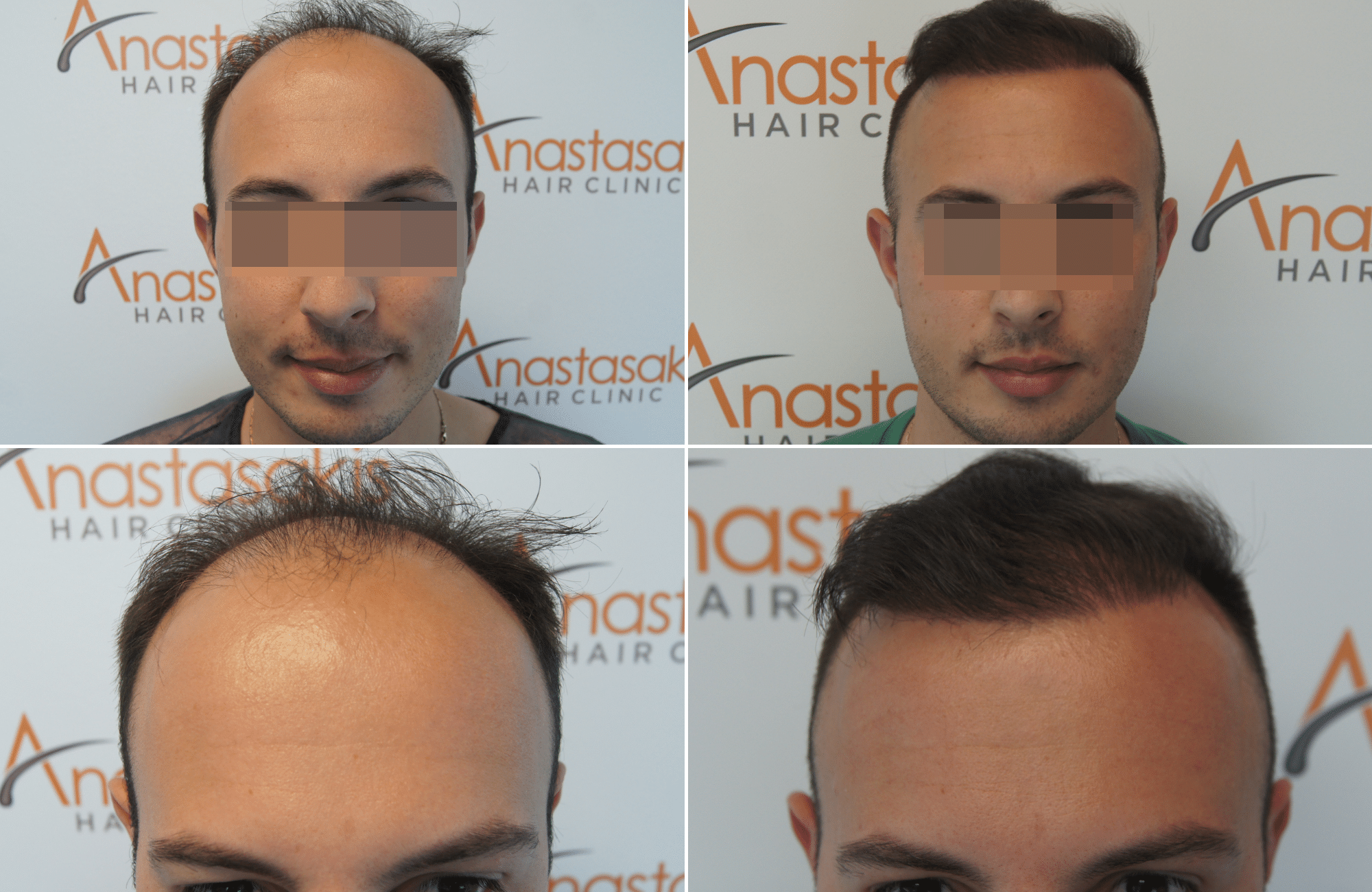 https://anastasakishairclinic.com/portfolio/apotelesma-metamosxefsis-mallion-anastasakis-hair-clinic-180/