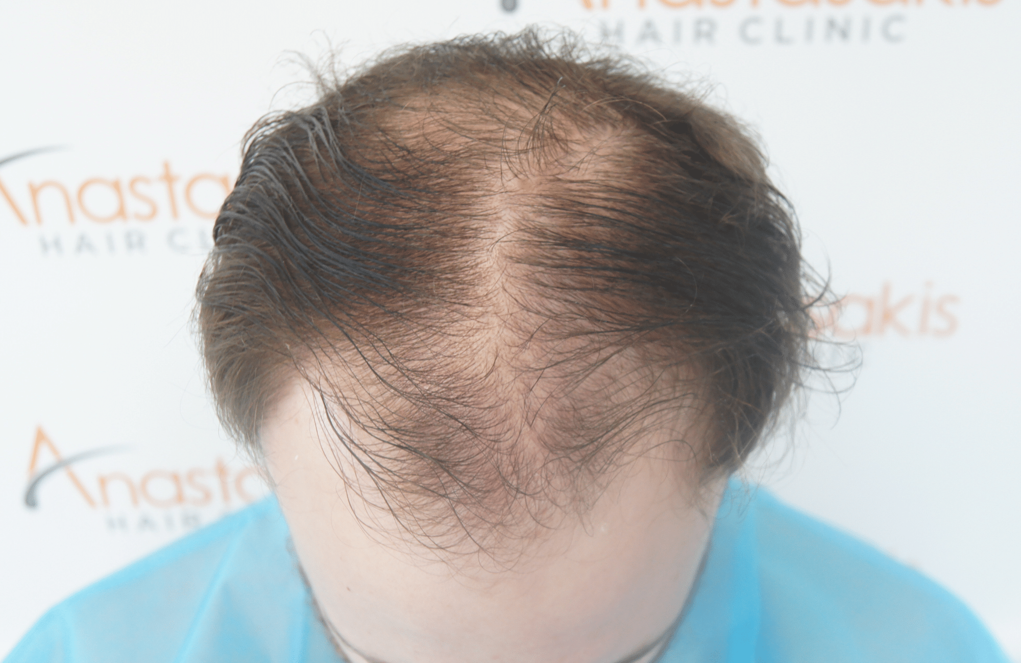 hair transplant result with 2500 follicular units anastasakis hair clinic