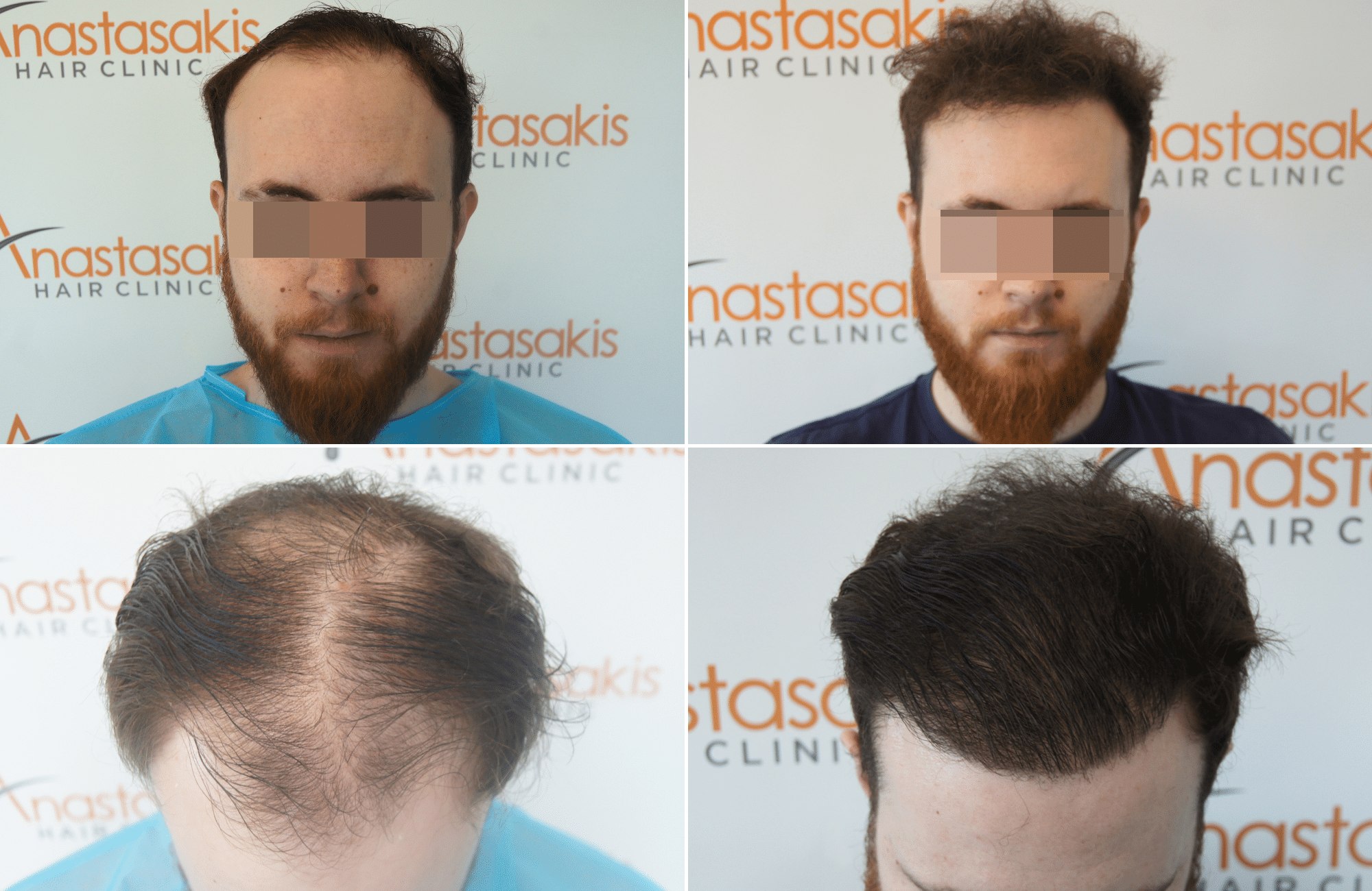 https://anastasakishairclinic.com/portfolio/ahc-apotelesma-metamosxefsis-mallion-anastasakis-hair-clinic-205/
