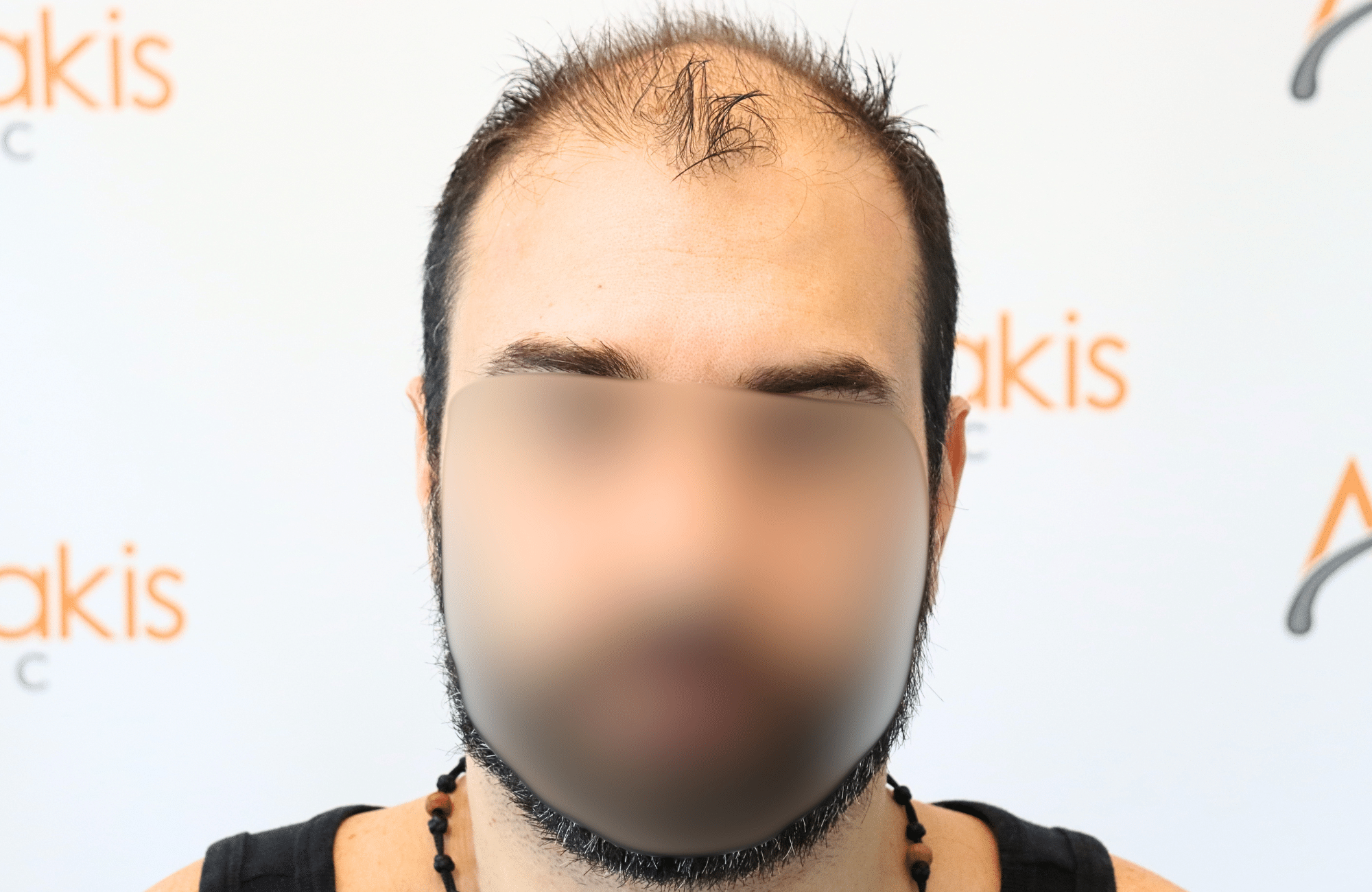 hair transplant result in 40-year-old man with 2600 fus anastasakis hair clinic fullface before