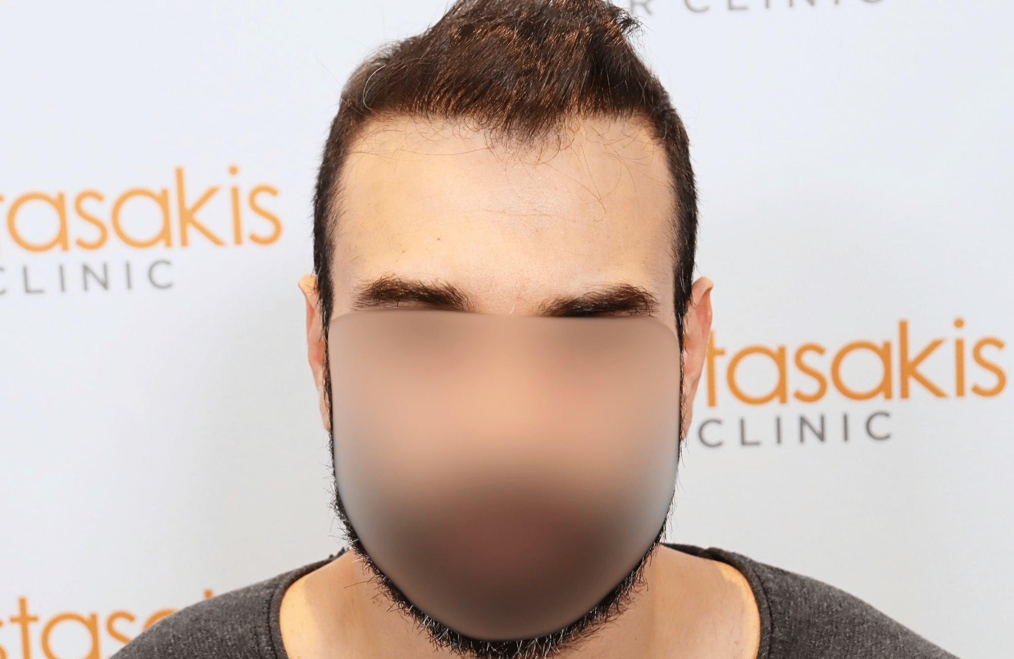 hair transplant result in 40-year-old man with 2600 fus anastasakis hair clinic fullface after