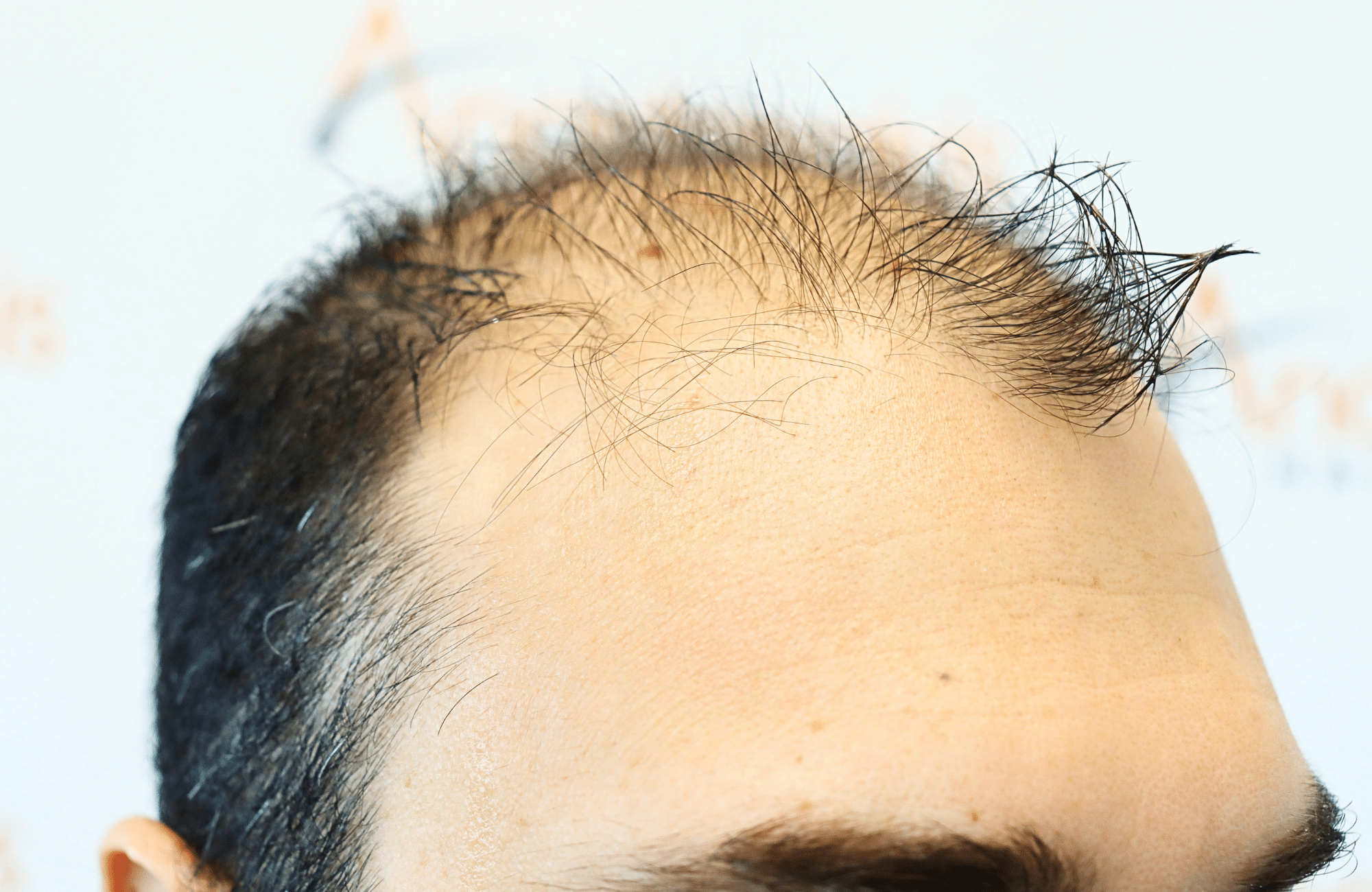hair transplant result in 40-year-old man with 2600 fus anastasakis hair clinic side1 before