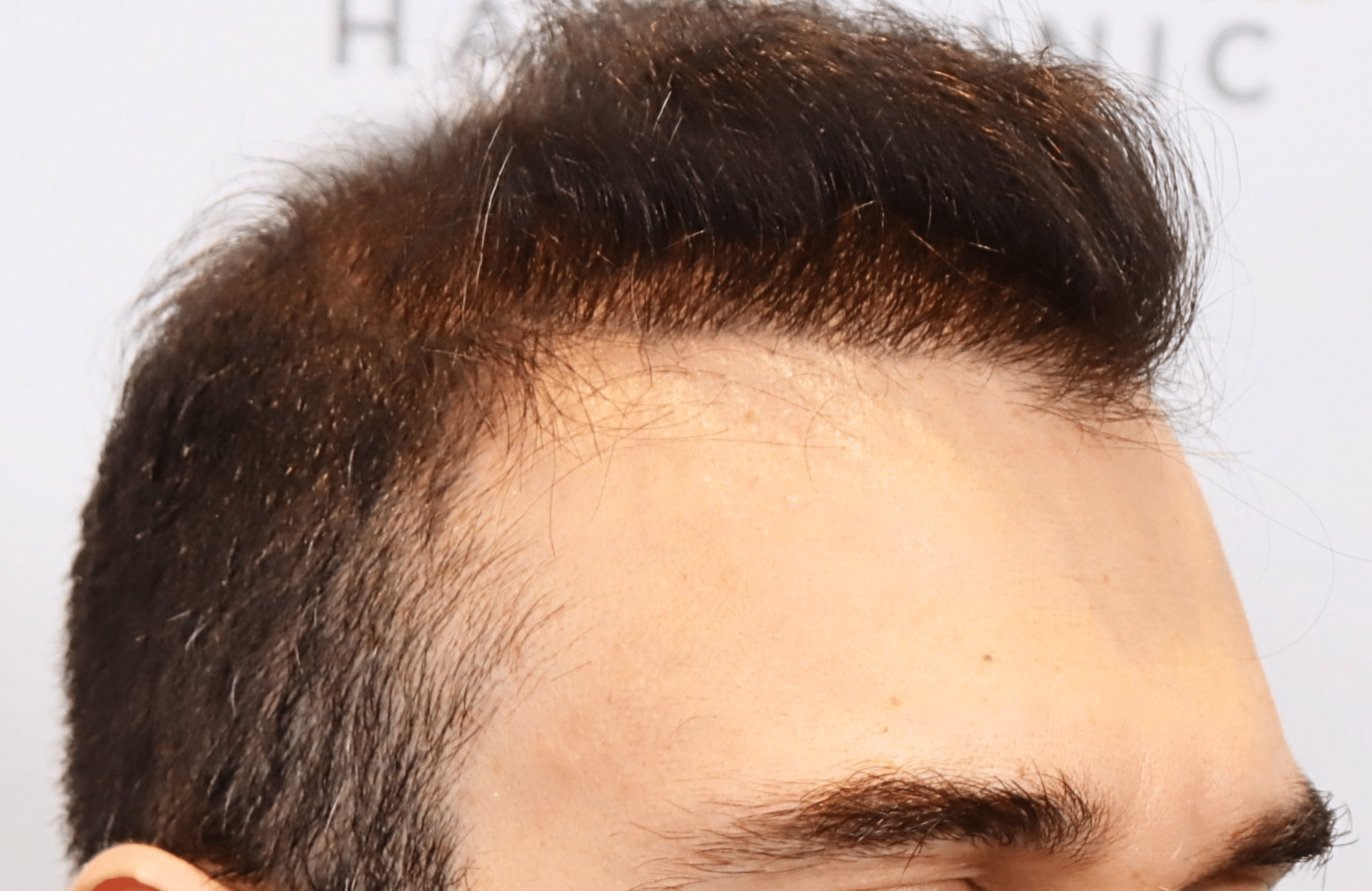 hair transplant result in 40-year-old man with 2600 fus anastasakis hair clinic side1 after