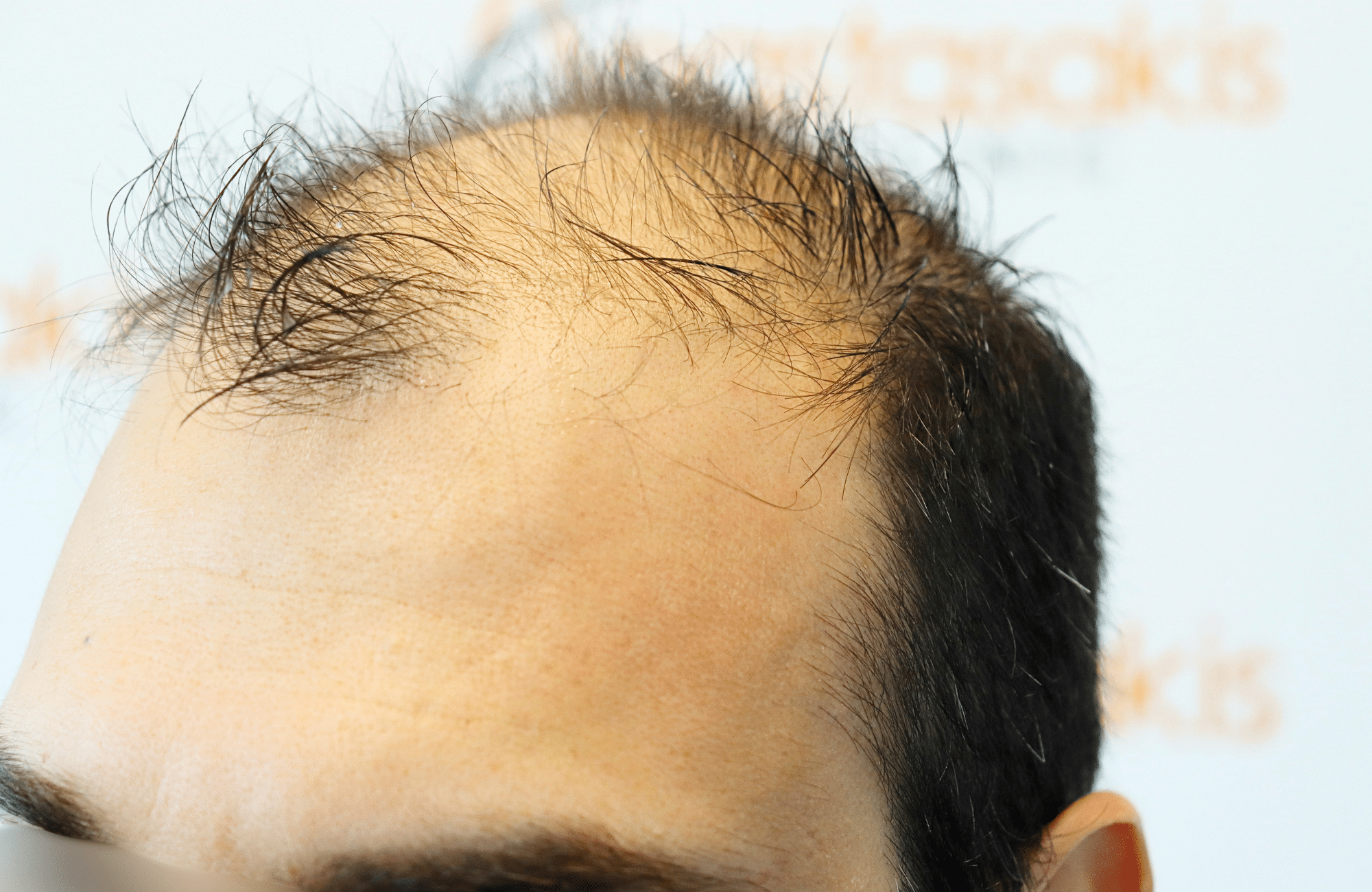hair transplant result in 40-year-old man with 2600 fus anastasakis hair clinic side2 before