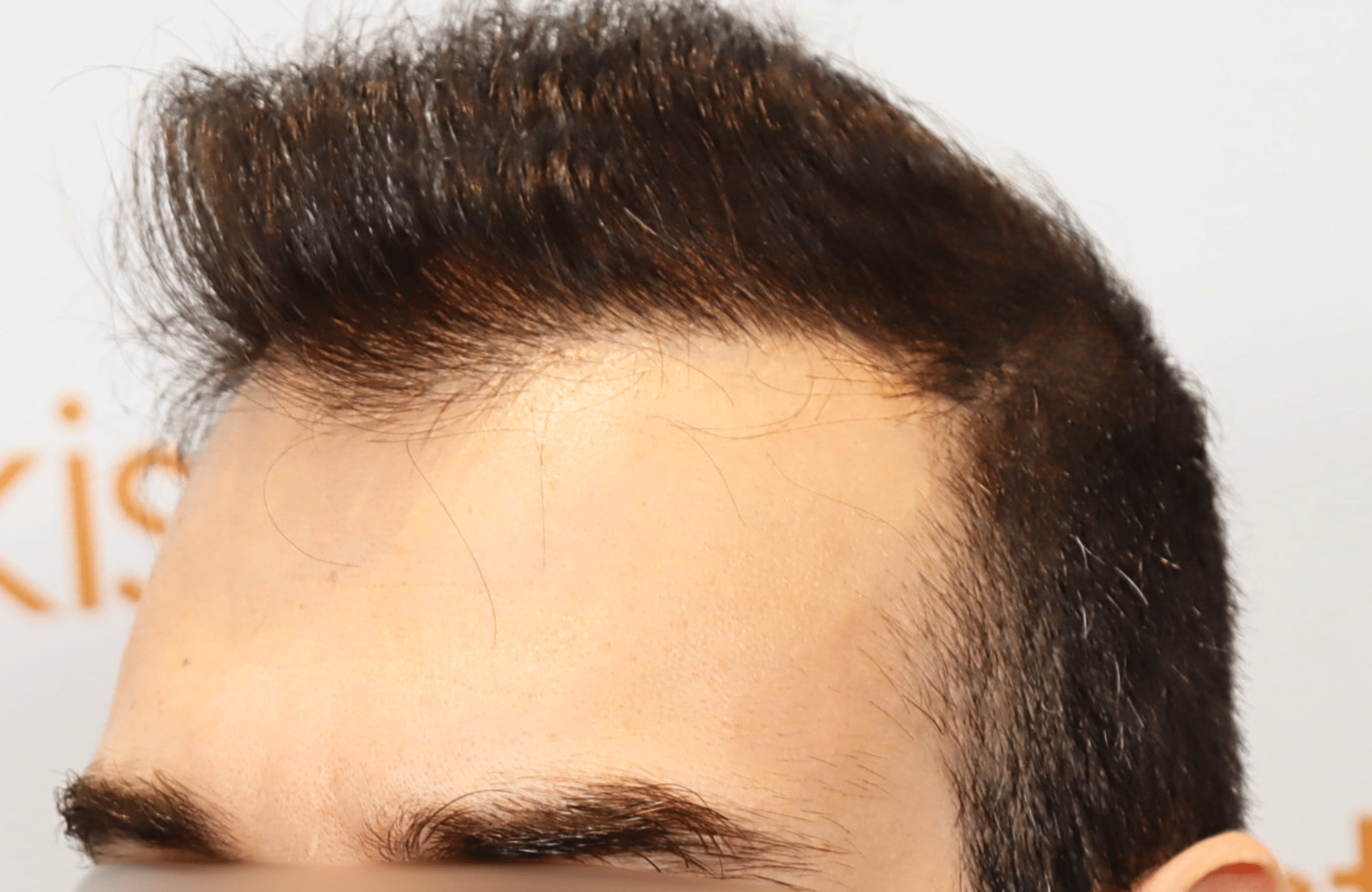 hair transplant result in 40-year-old man with 2600 fus anastasakis hair clinic side2 after
