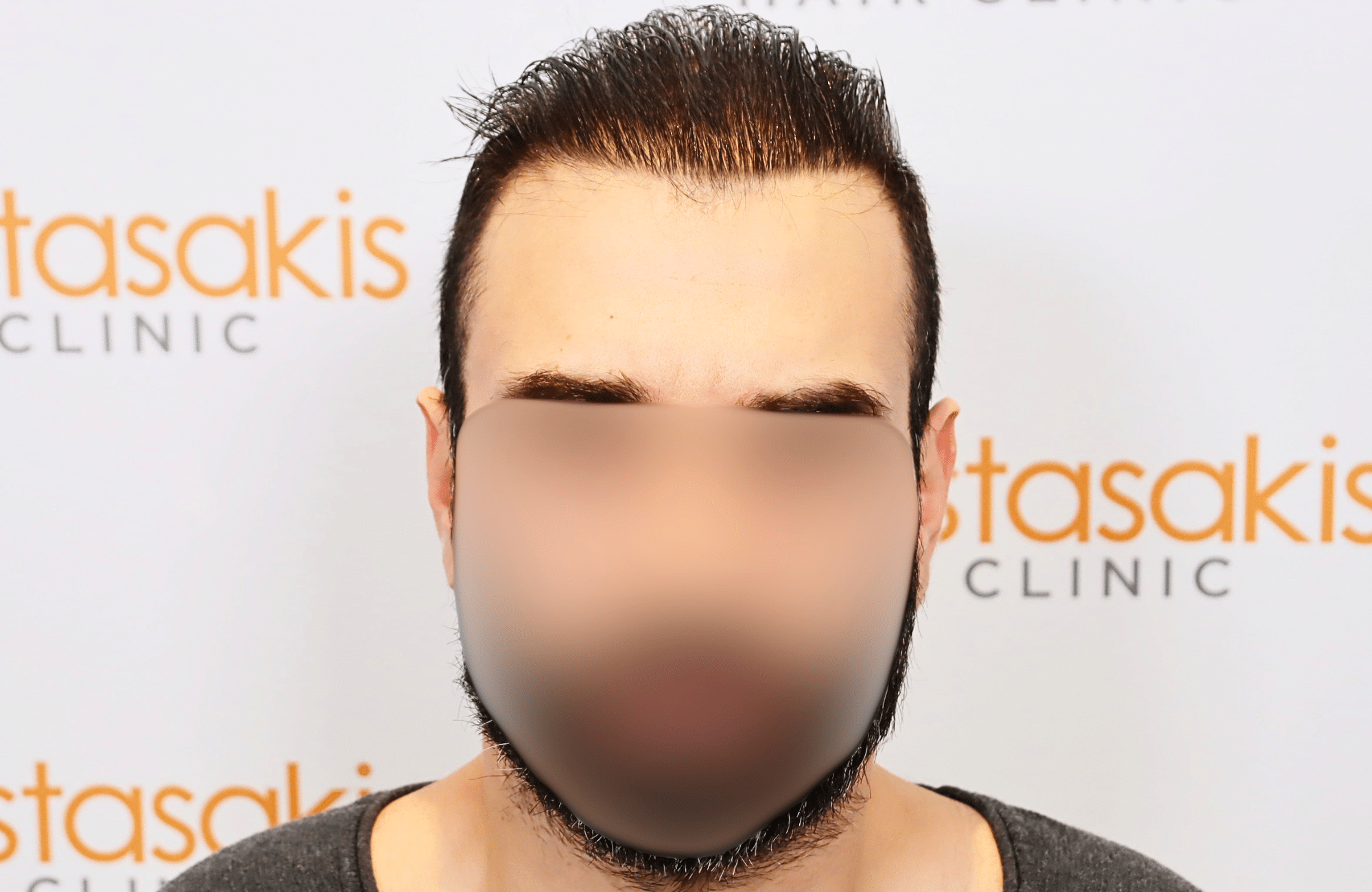 hair transplant result in 40-year-old man with 2600 fus anastasakis hair clinic fullface after wet hair