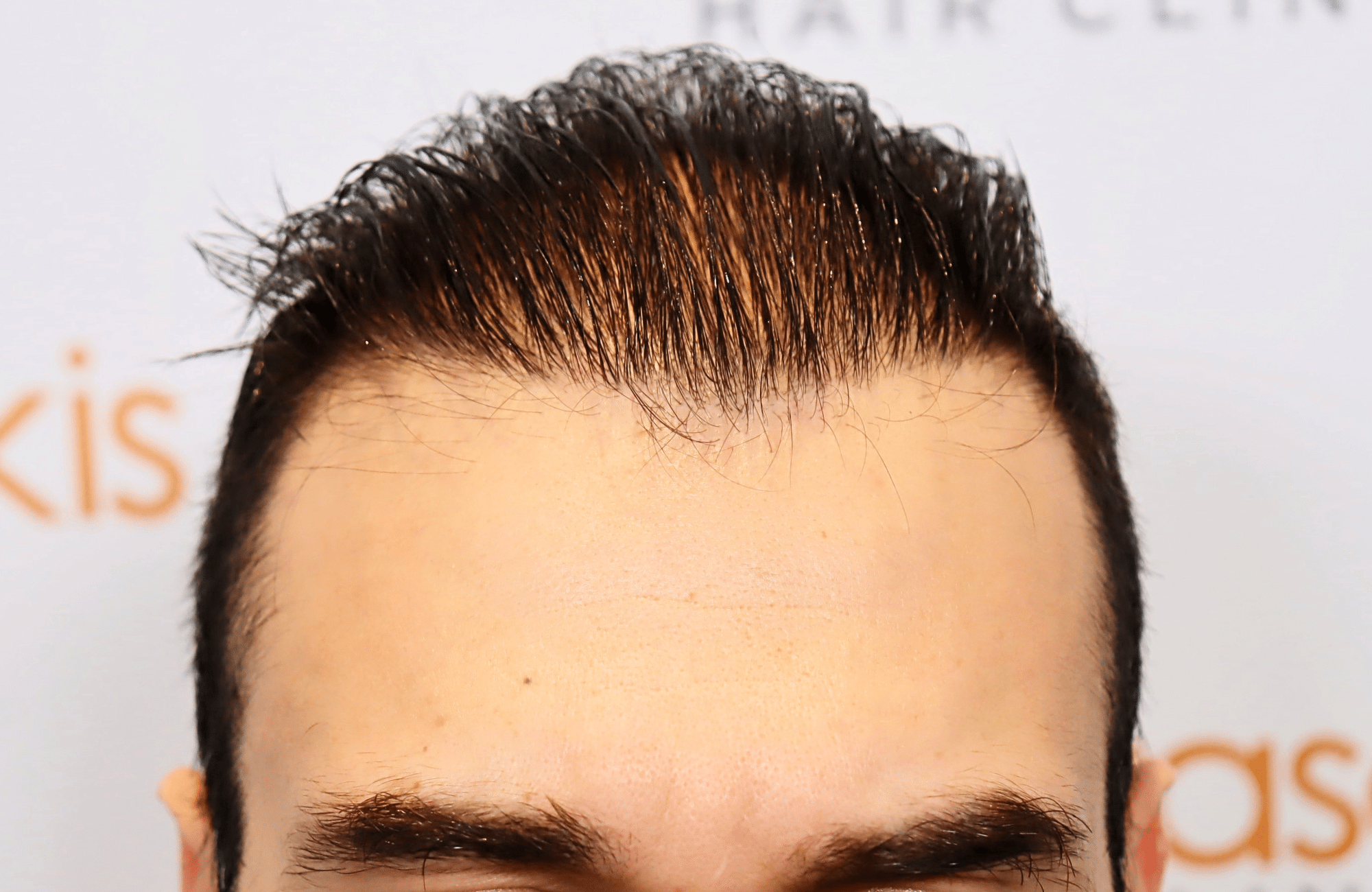 hair transplant result in 40-year-old man with 2600 fus anastasakis hair clinic hairline after wet hair