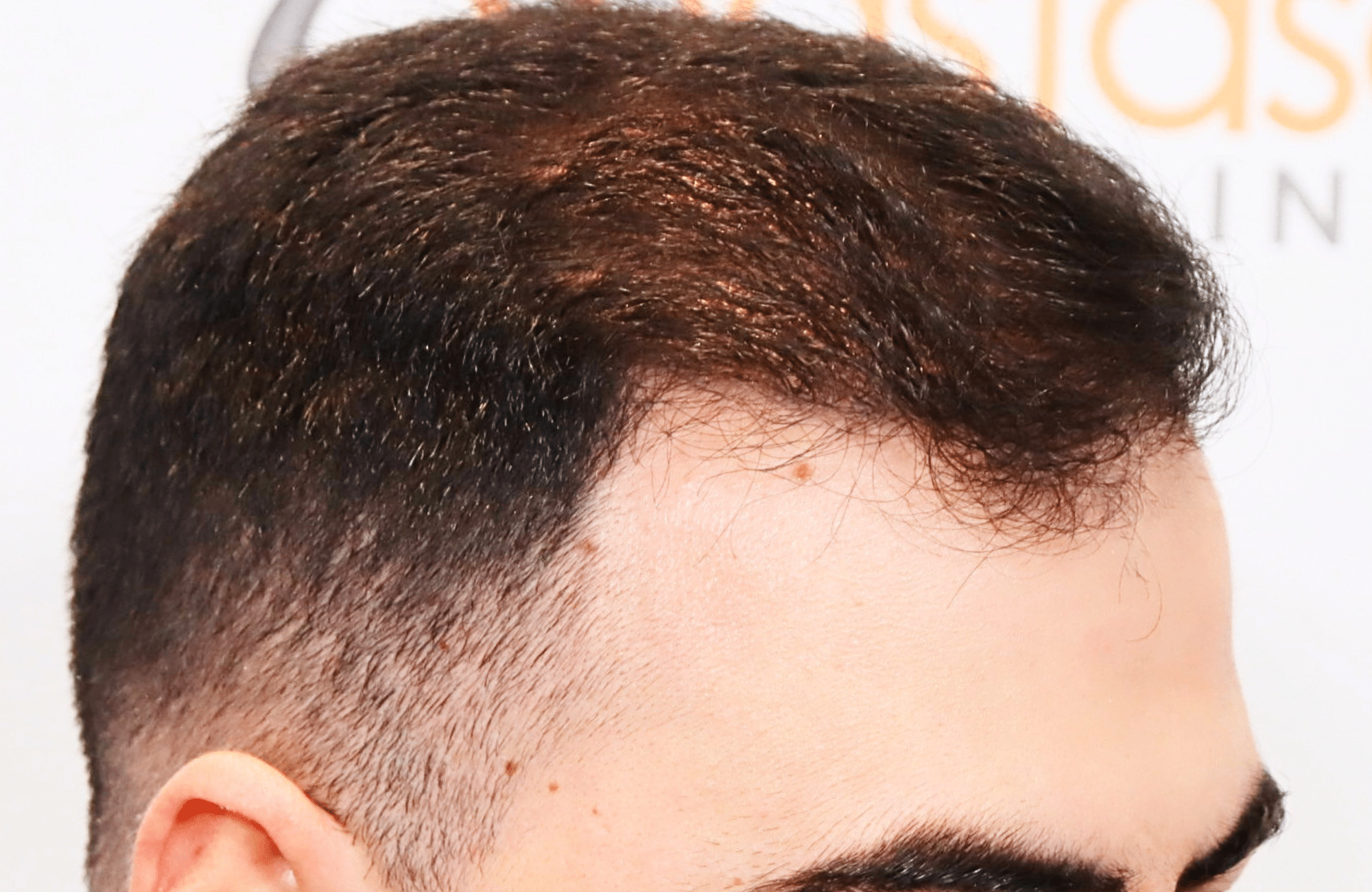 hair transplant result with 2600 fus with fue anastasakis hair clinic side2 after