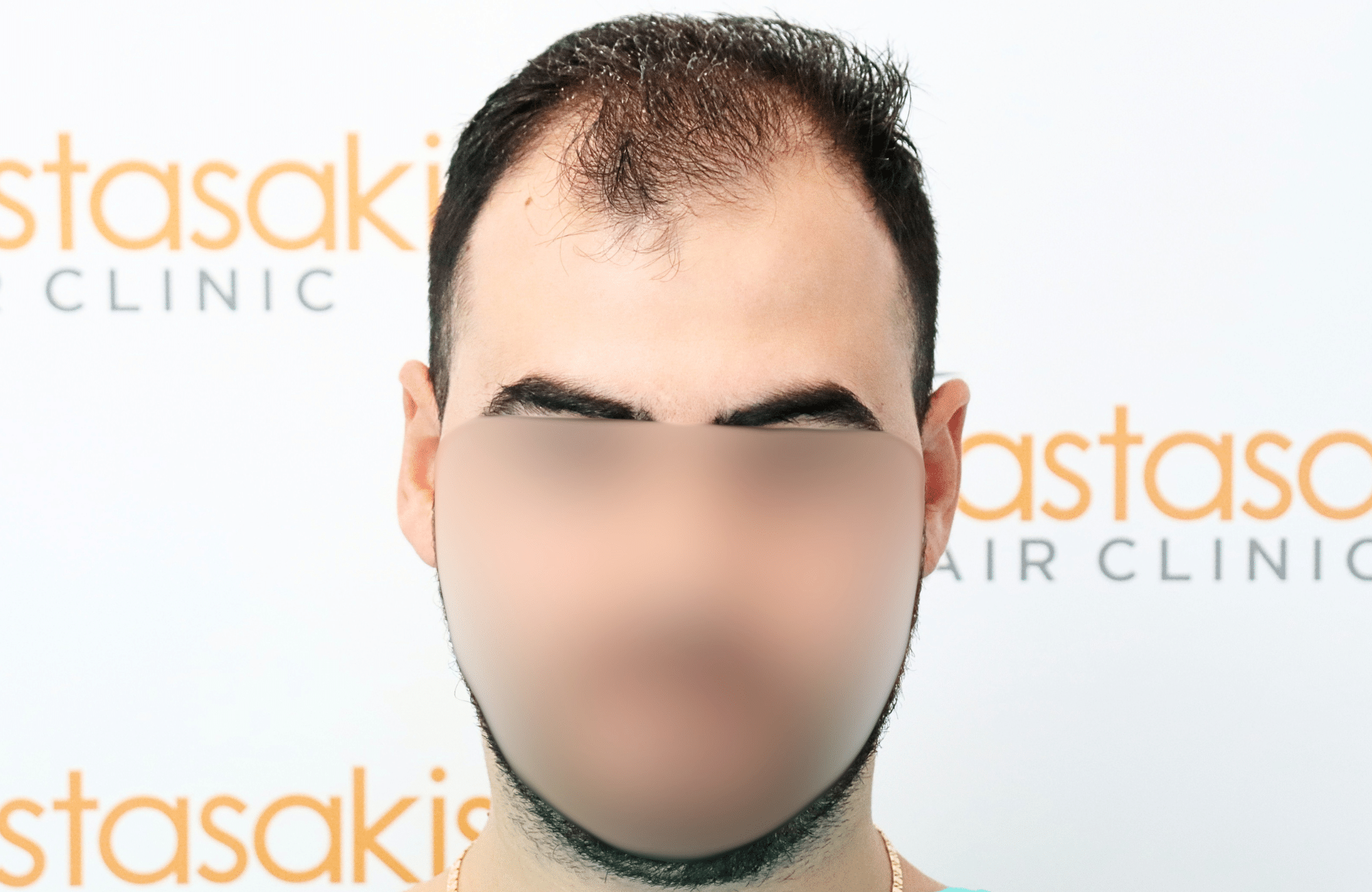hair transplant result with 2600 fus with fue anastasakis hair clinic fullface before