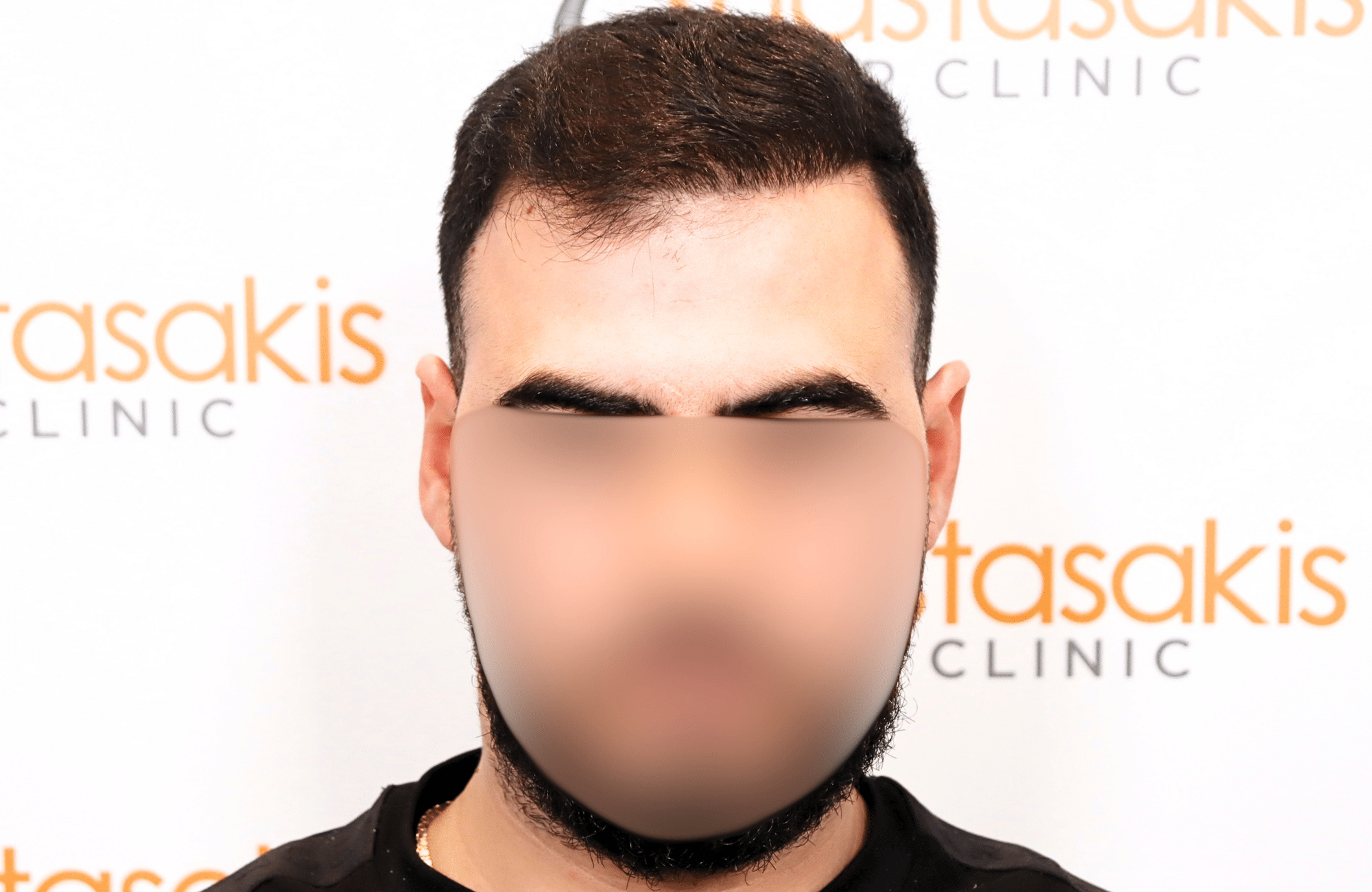 hair transplant result with 2600 fus with fue anastasakis hair clinic fullface after