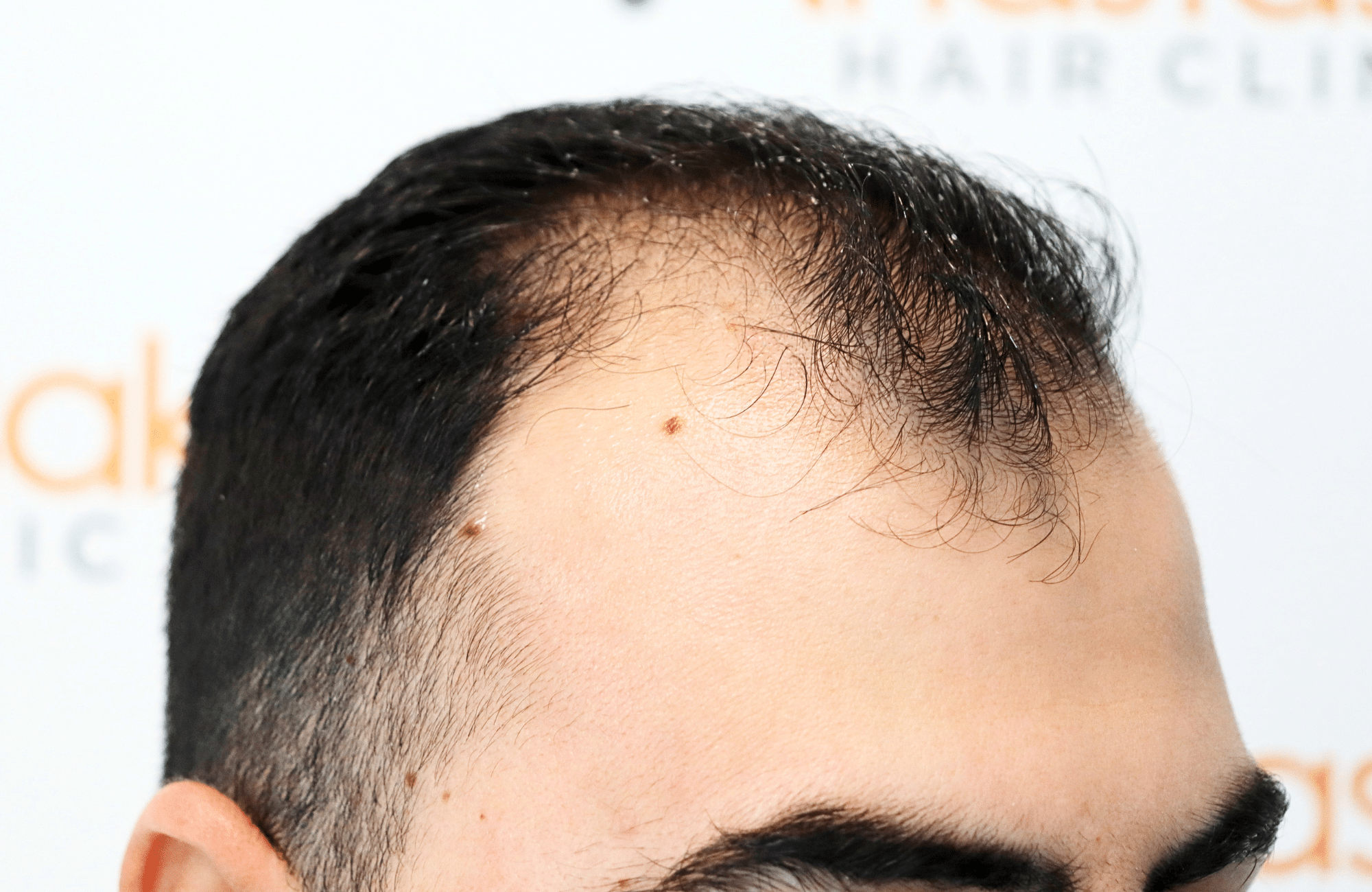 hair transplant result with 2600 fus with fue anastasakis hair clinic side2 before