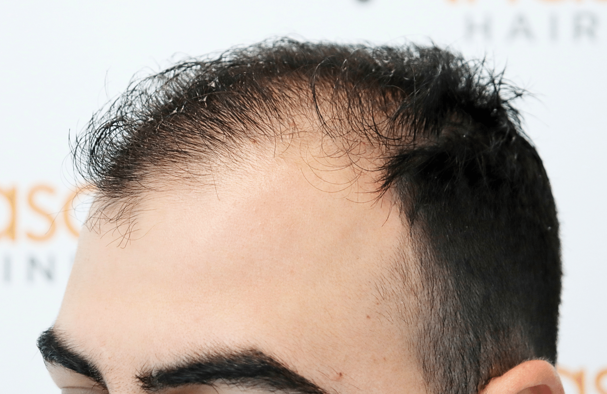 hair transplant result with 2600 fus with fue anastasakis hair clinic side1 before