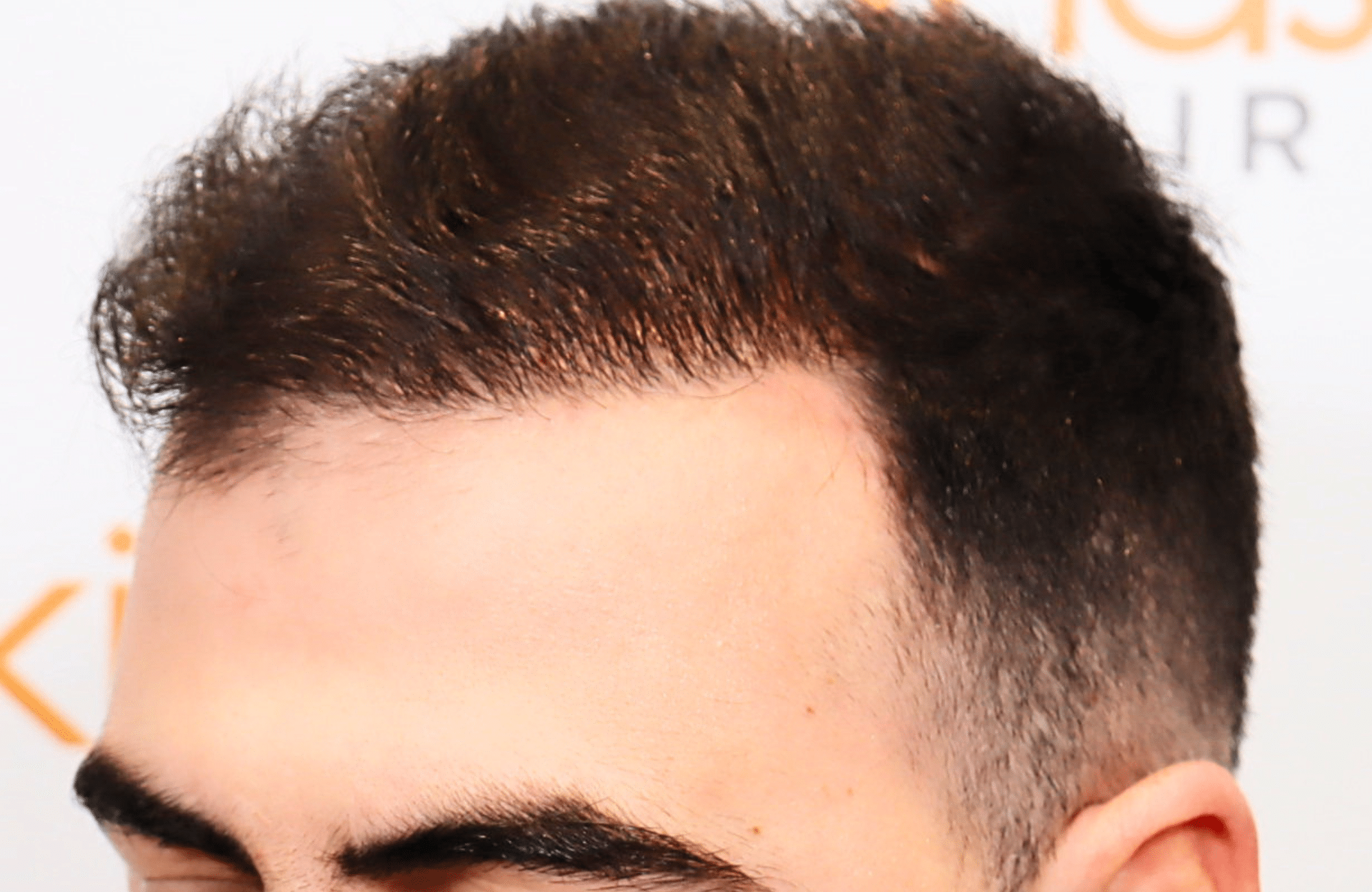 hair transplant result with 2600 fus with fue anastasakis hair clinic side1 after