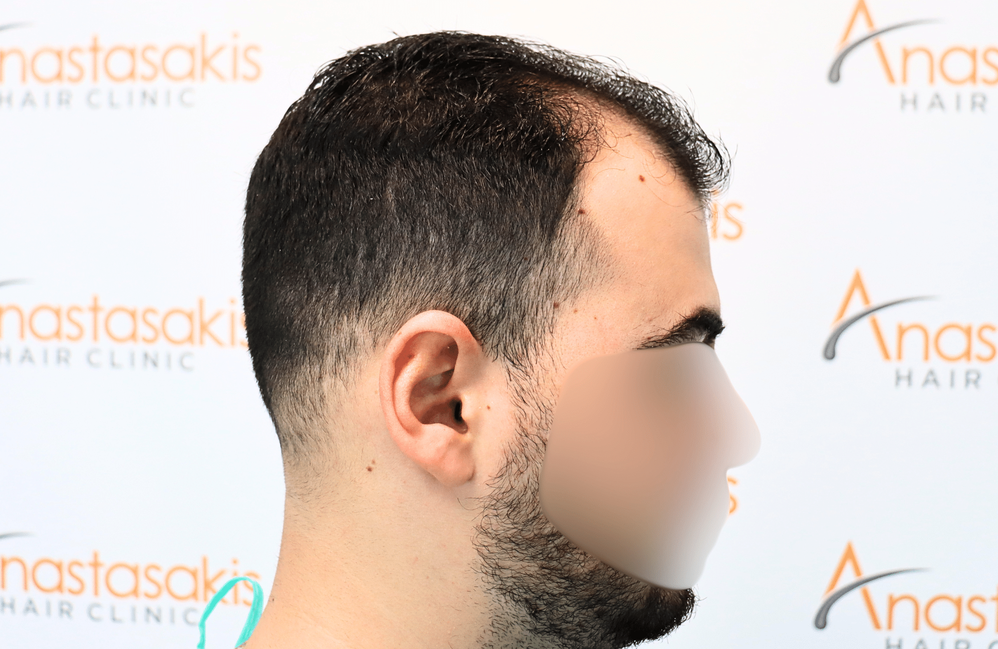 hair transplant result with 2600 fus with fue anastasakis hair clinic side3 before