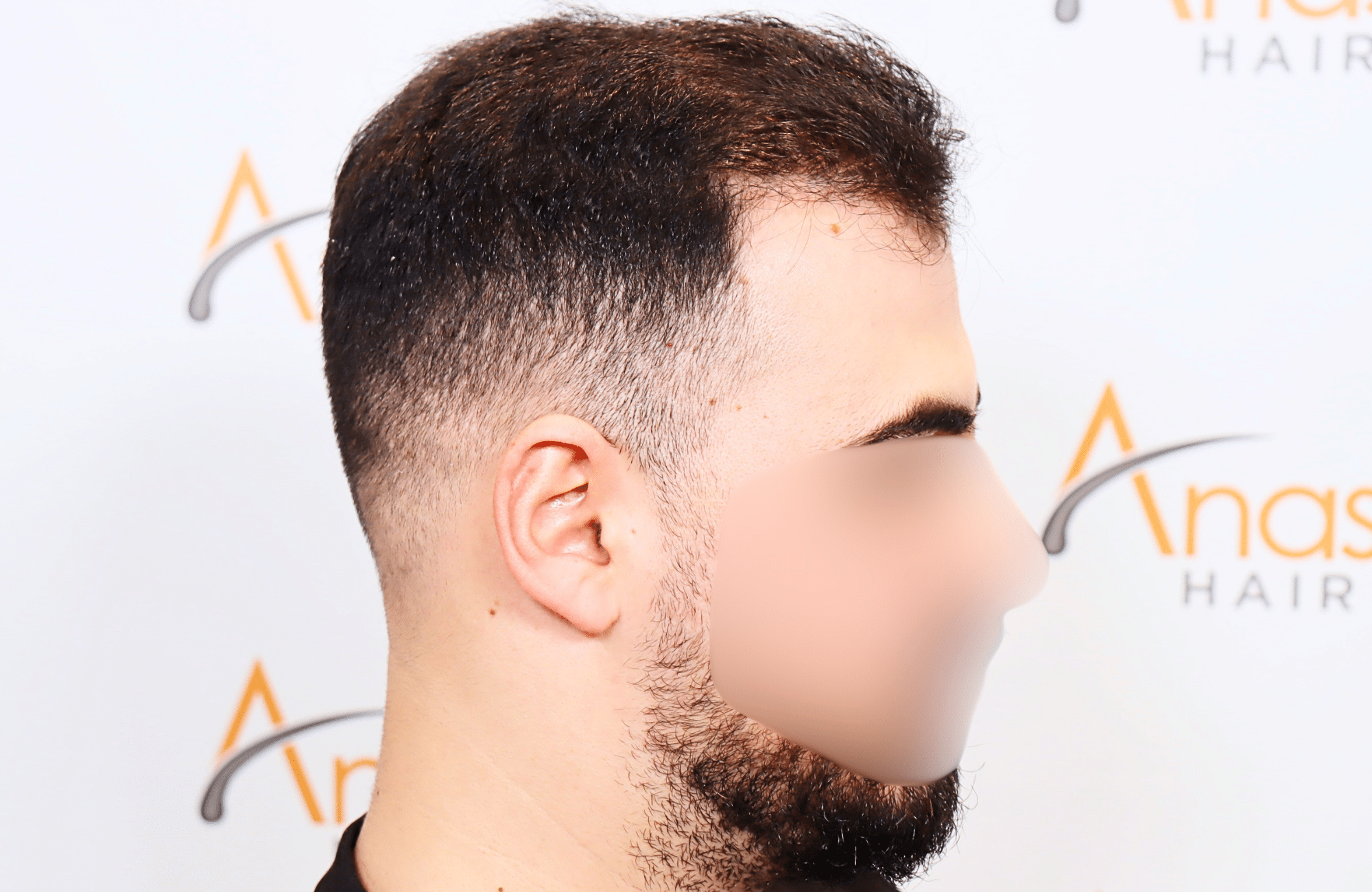 hair transplant result with 2600 fus with fue anastasakis hair clinic side3 after