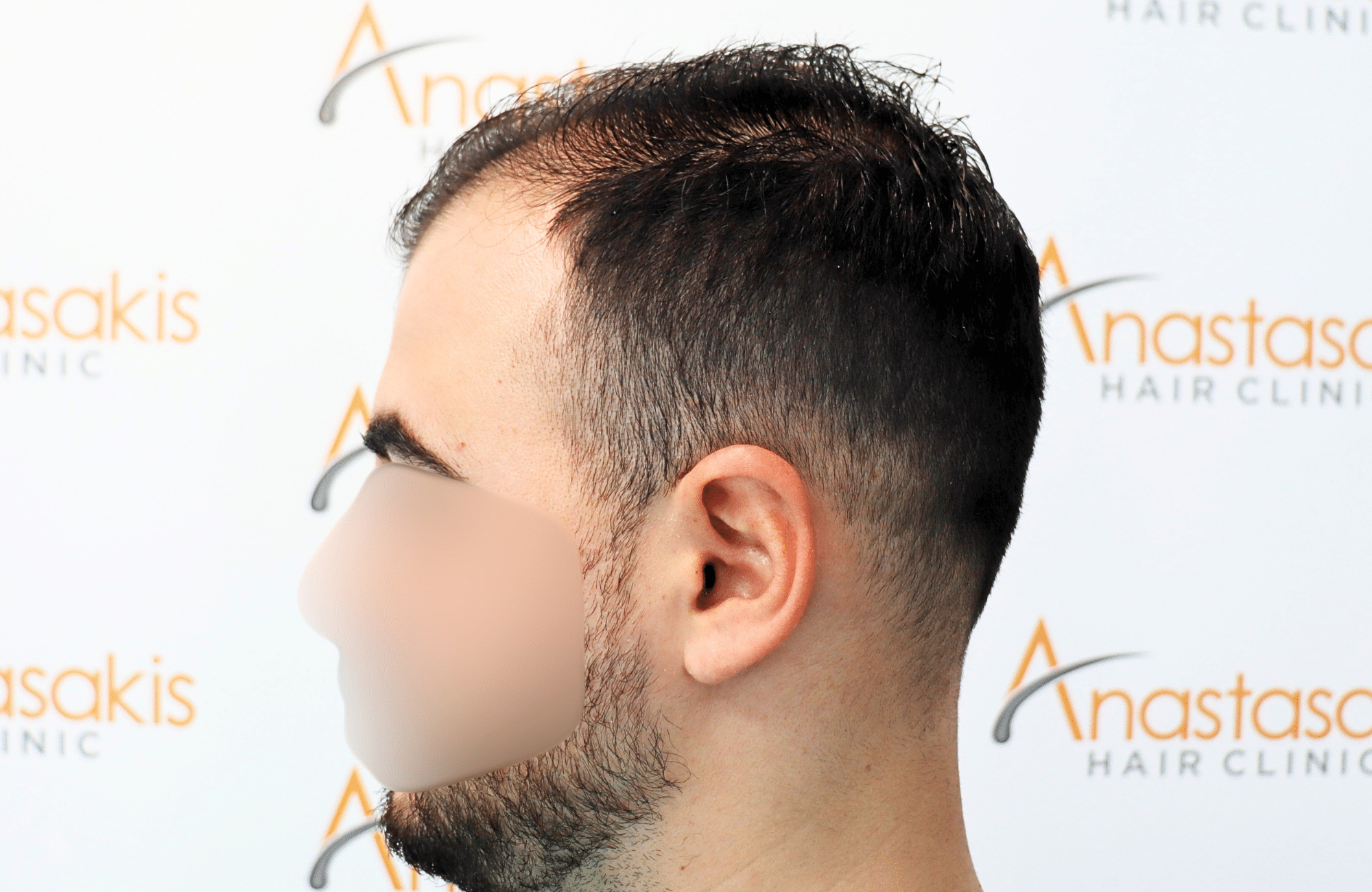 hair transplant result with 2600 fus with fue anastasakis hair clinic side4 before