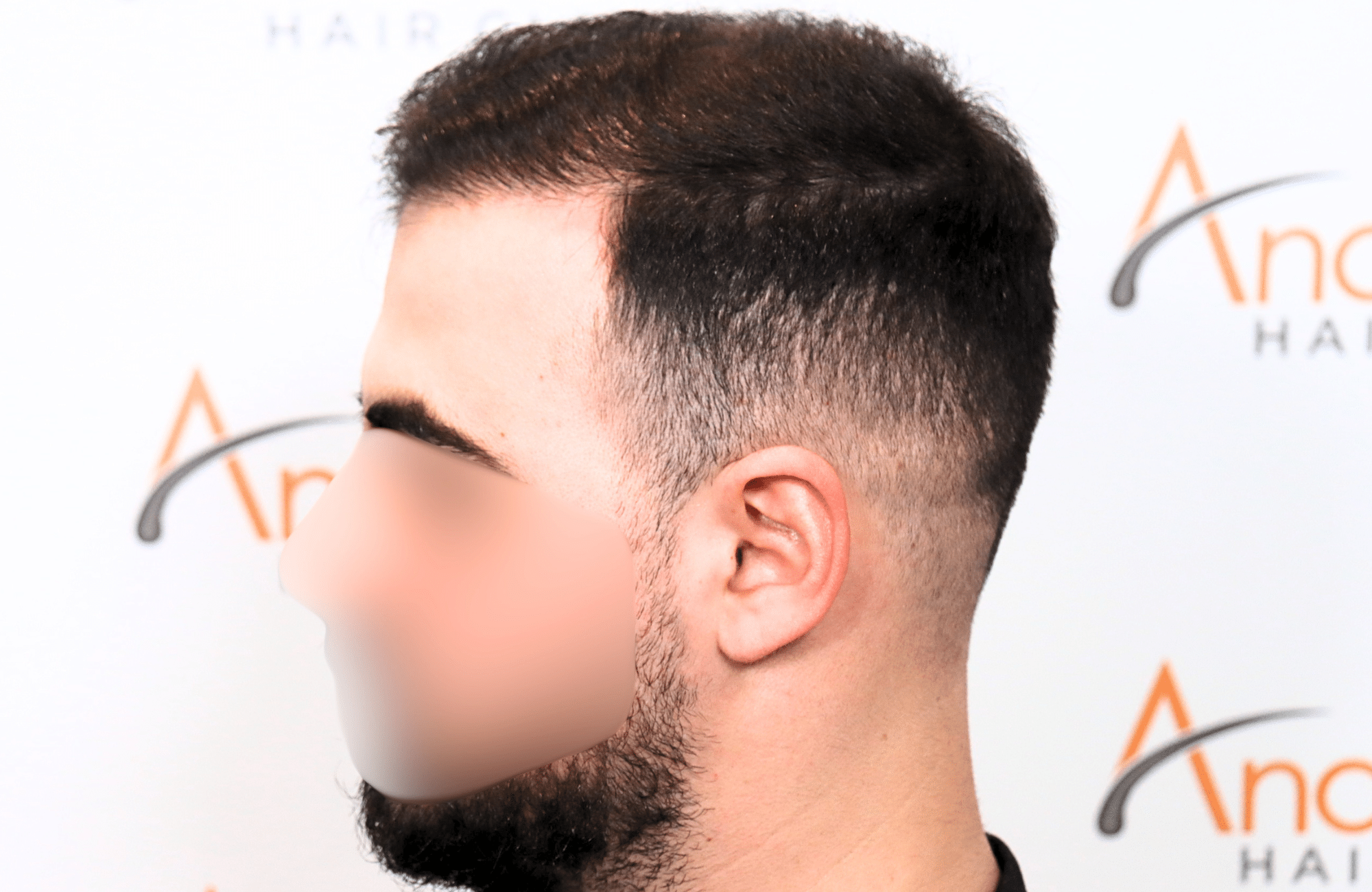 hair transplant result with 2600 fus with fue anastasakis hair clinic side4 after