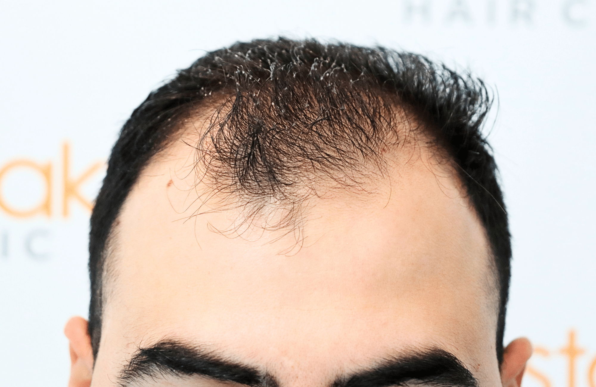 hair transplant result with 2600 fus with fue anastasakis hair clinic hairline before